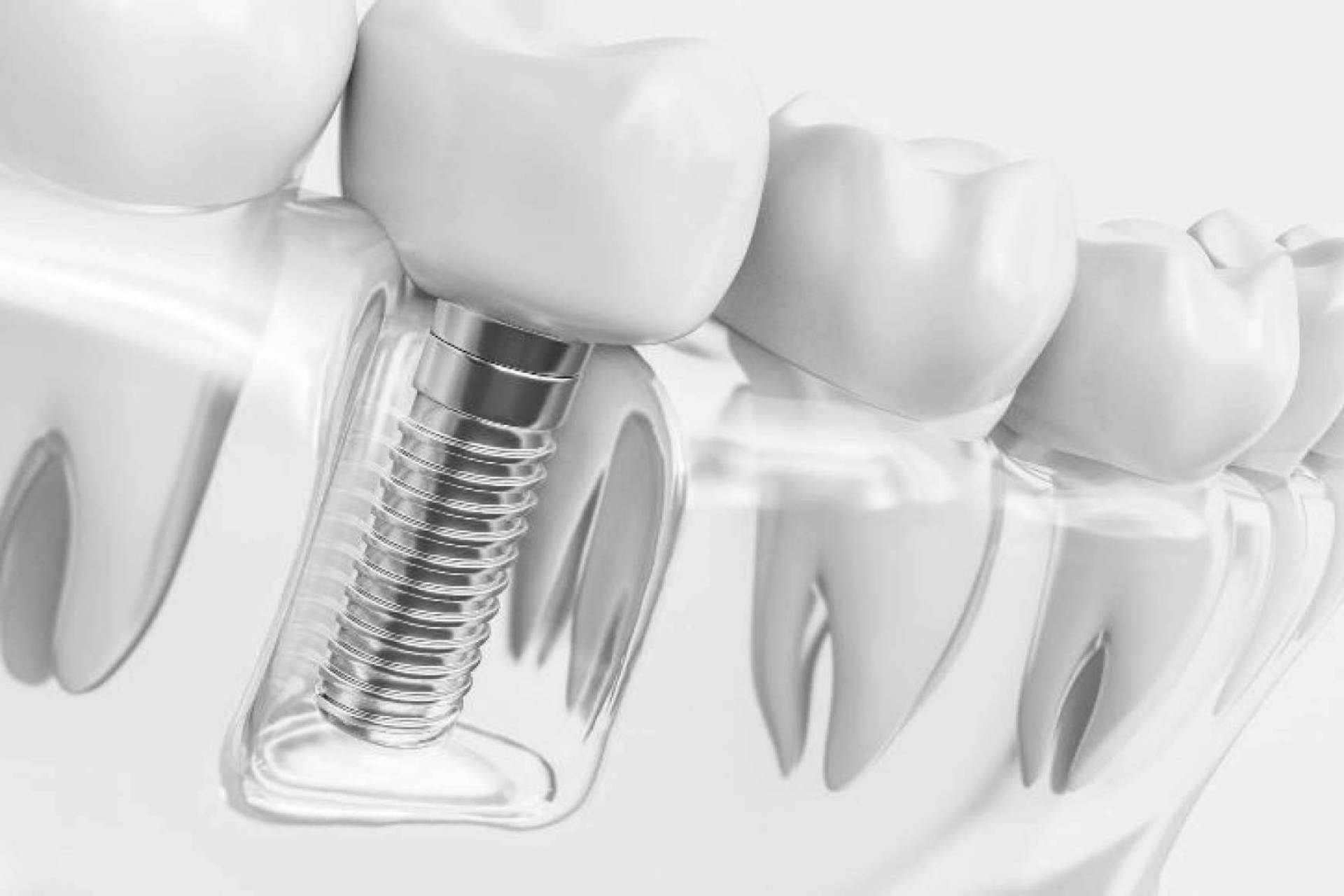 Grupo Gente Vital, tratamientos de calidad de ortodoncia invisible