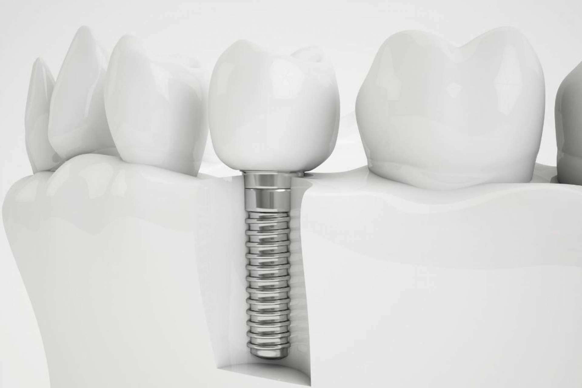 Grupo Gente Vital y la colocación de implantes dentales
