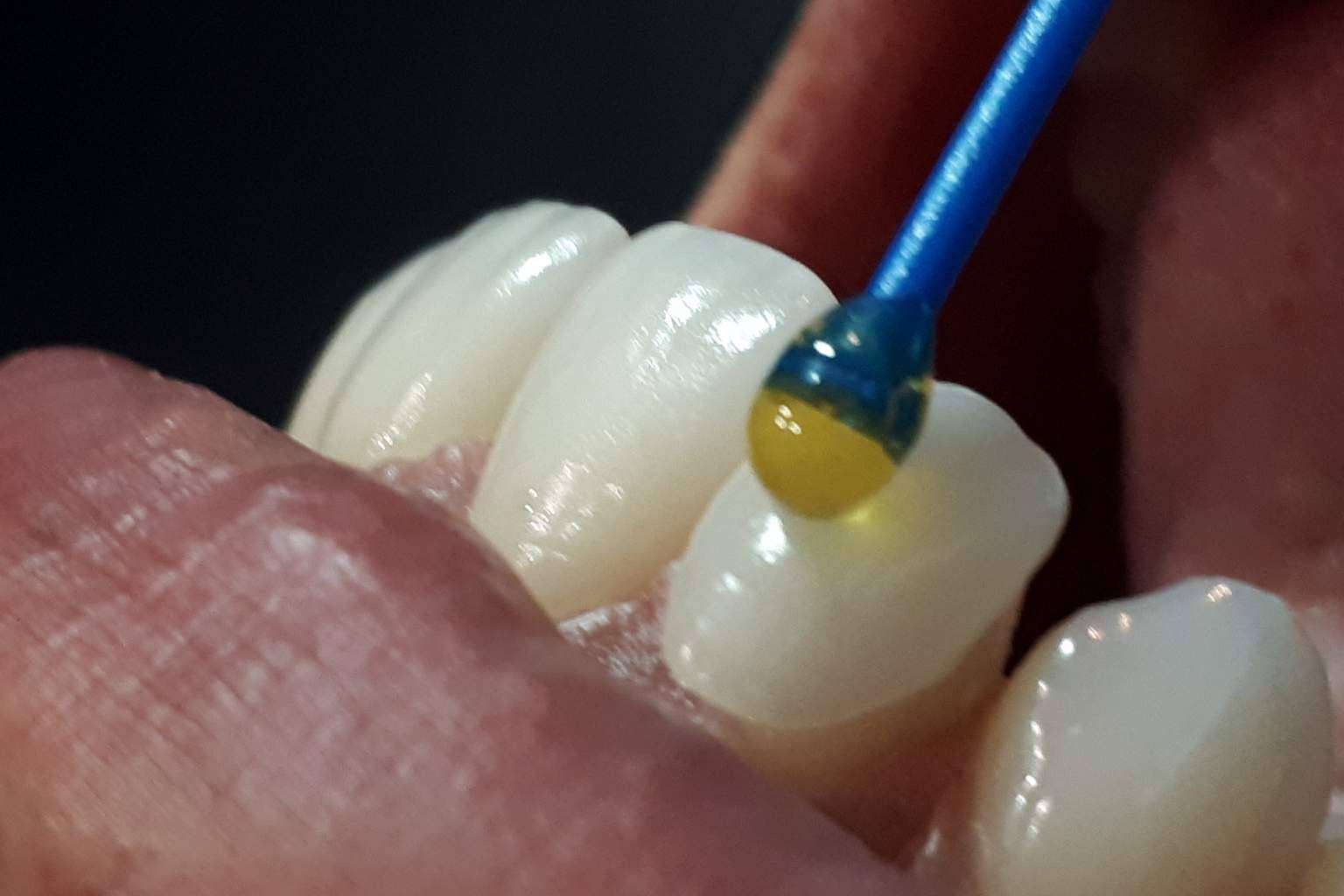 Dentinova, la opción para conseguir una sonrisa Hollywood