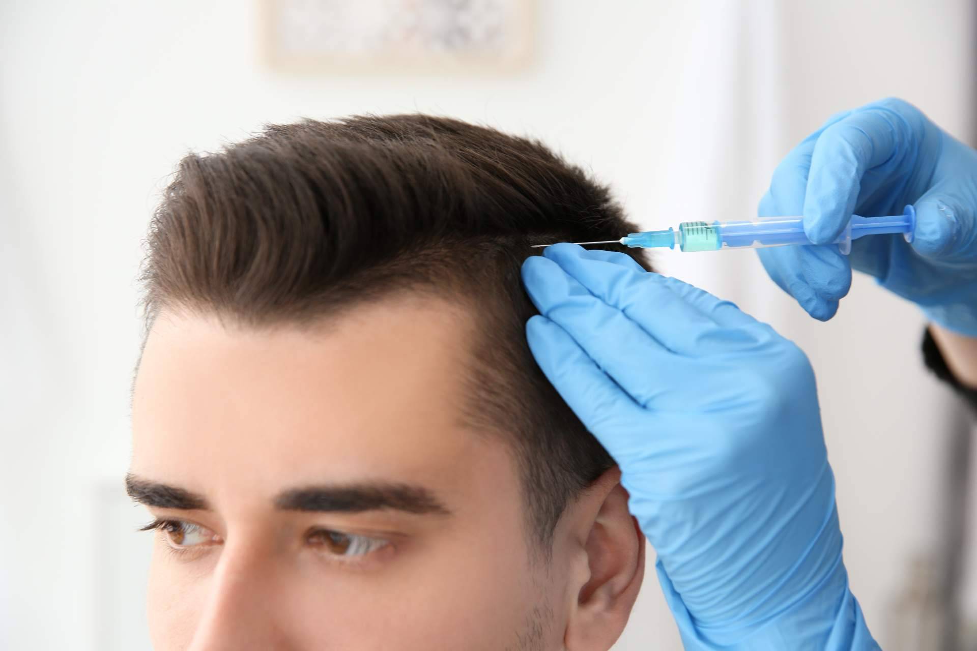 Nanofat, el tratamiento capilar de Clínica Tarrazo que pone fin a la alopecia