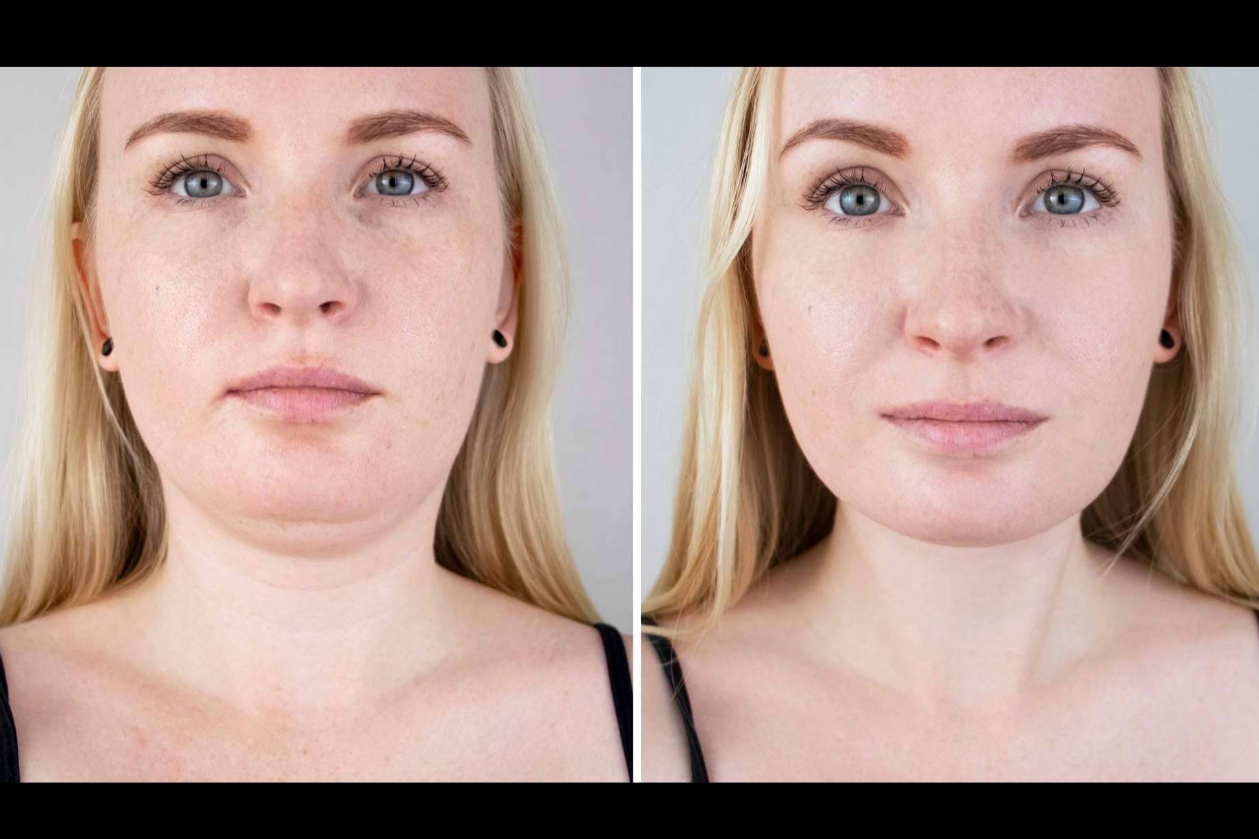 Eliminar la papada y la flacidez facial es posible con el lifting láser, de la mano de Clínica Femme