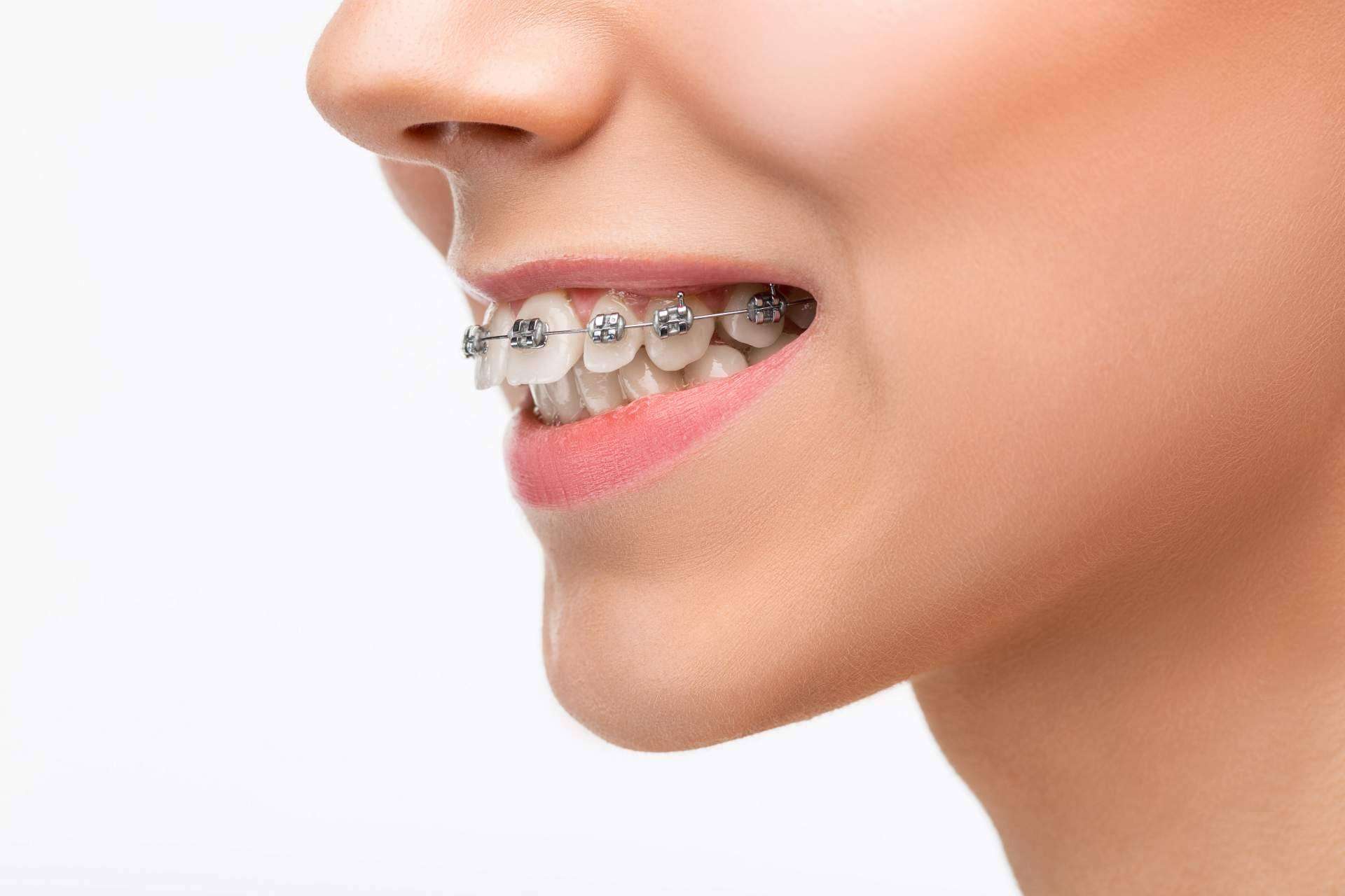 Corregir a tiempo garantiza una óptima salud bucal, la ortodoncia infantil en Córdoba de la mano de Corporación Dental
