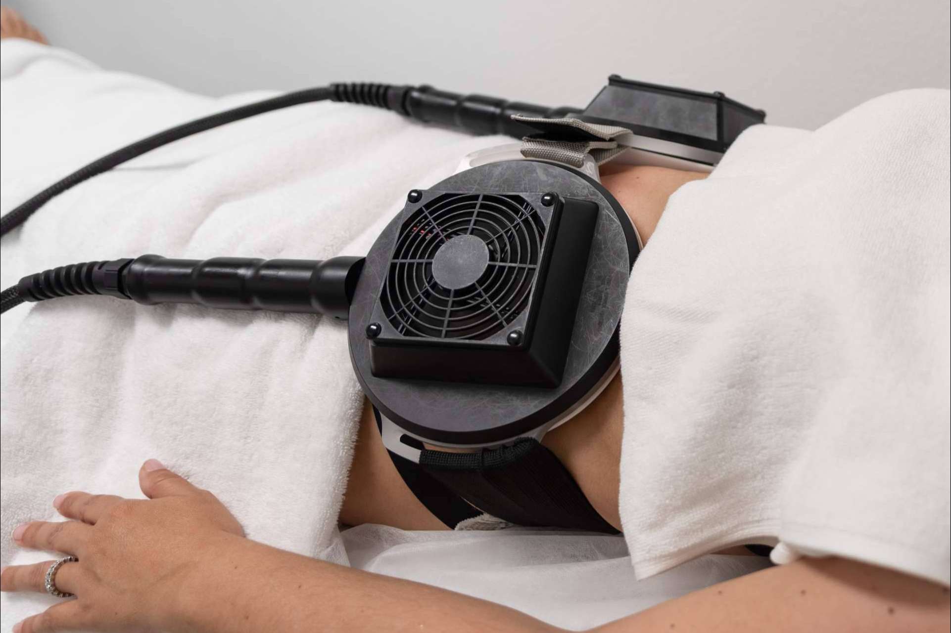 Tratamientos combinados de criolipólisis y estimulación electromagnética para reducir la grasa localizada
