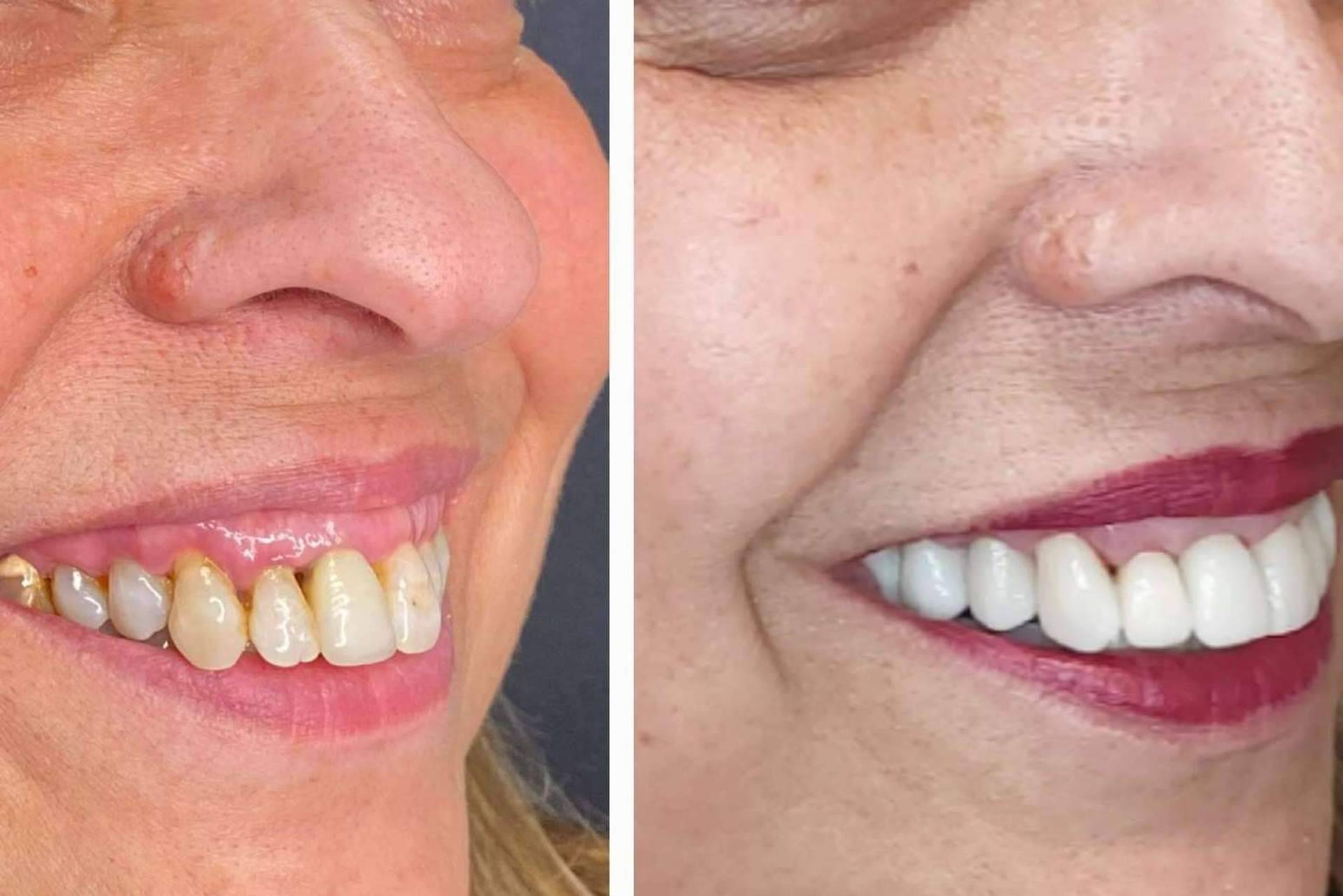 Todo lo que hay que saber sobre las carillas dentales, por Dentinova