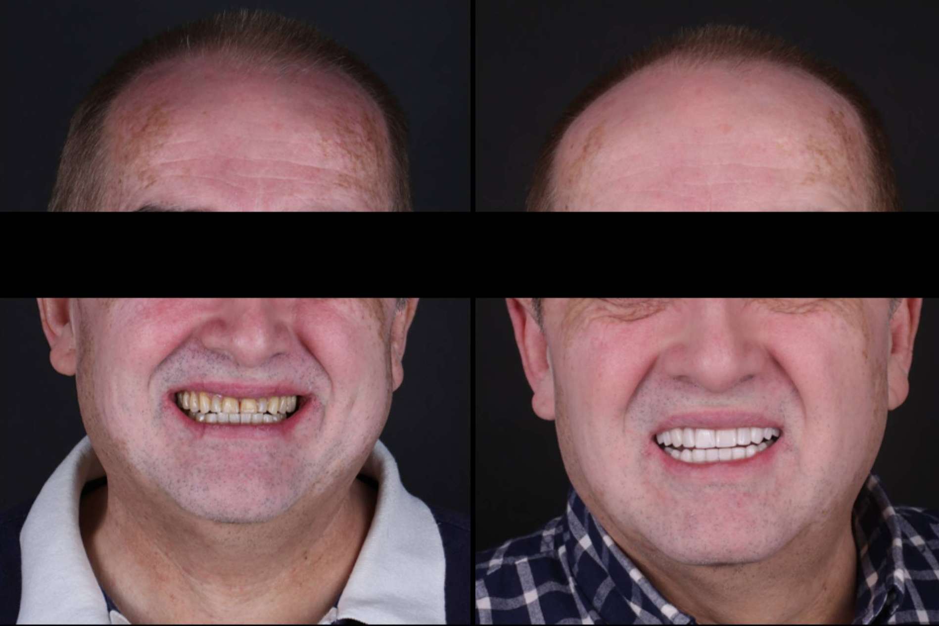 Las ventajas de las carillas dentales, de la mano de los profesionales de Carillas Wikend®