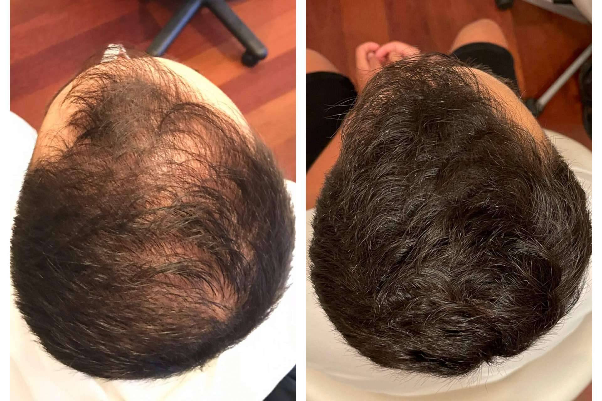 La clínica dermatológica De Felipe realiza infiltraciones dutasteride para tratar la alopecia