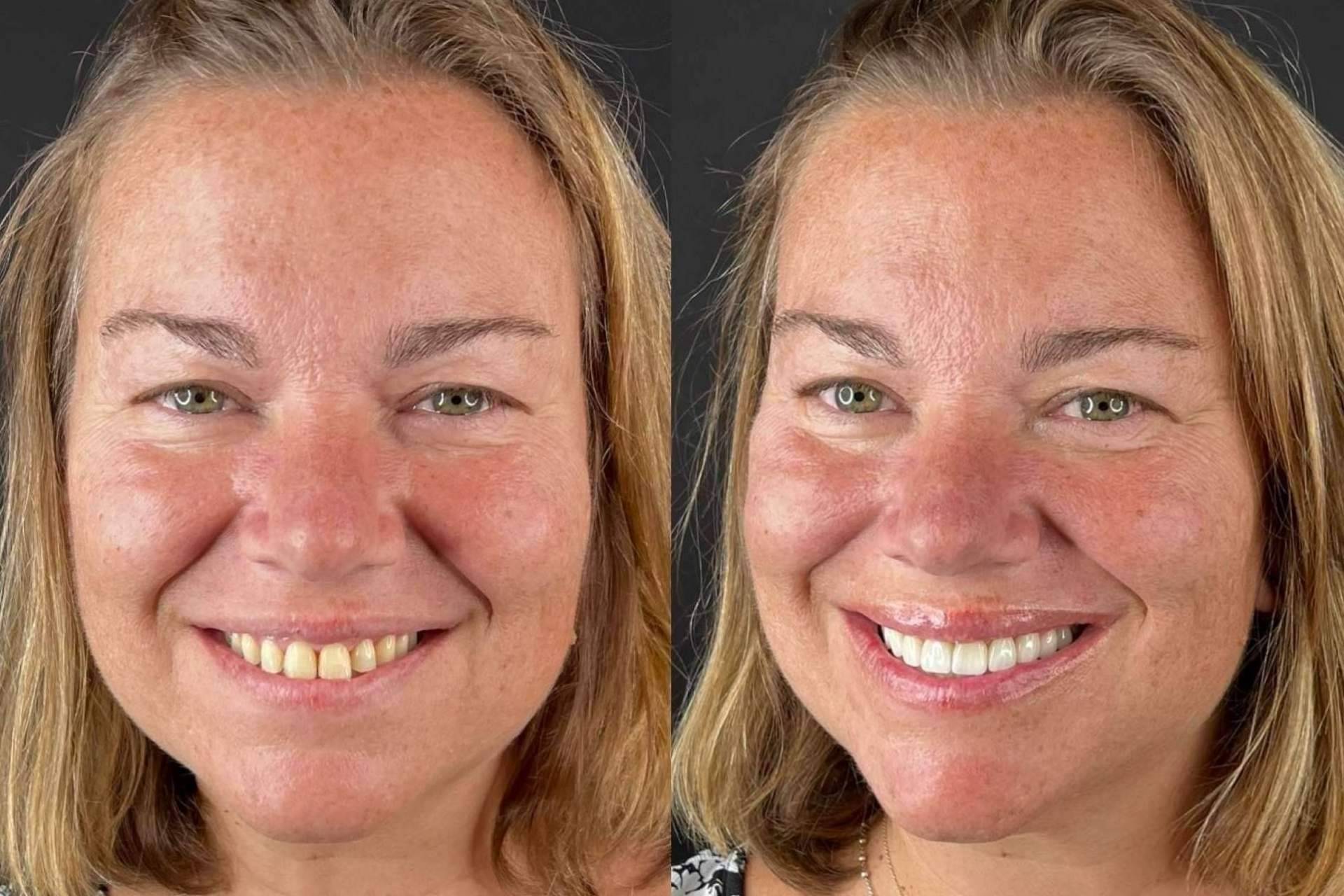 Ponerse carillas dentales sin tallado de dientes en Madrid es posible de la mano de Carillas Wikend®