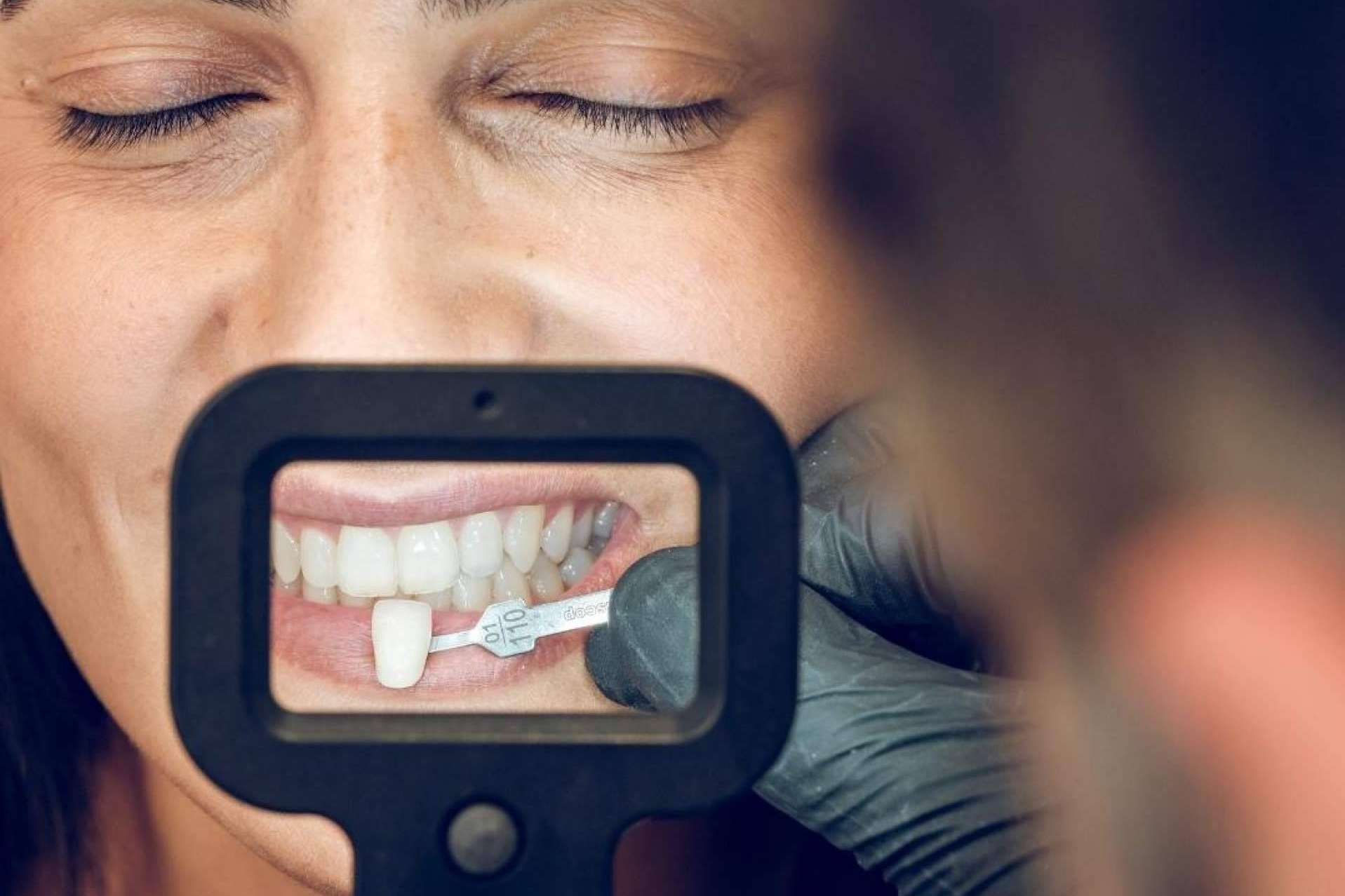 Carillas dentales, la solución en un día para recuperar la sonrisa