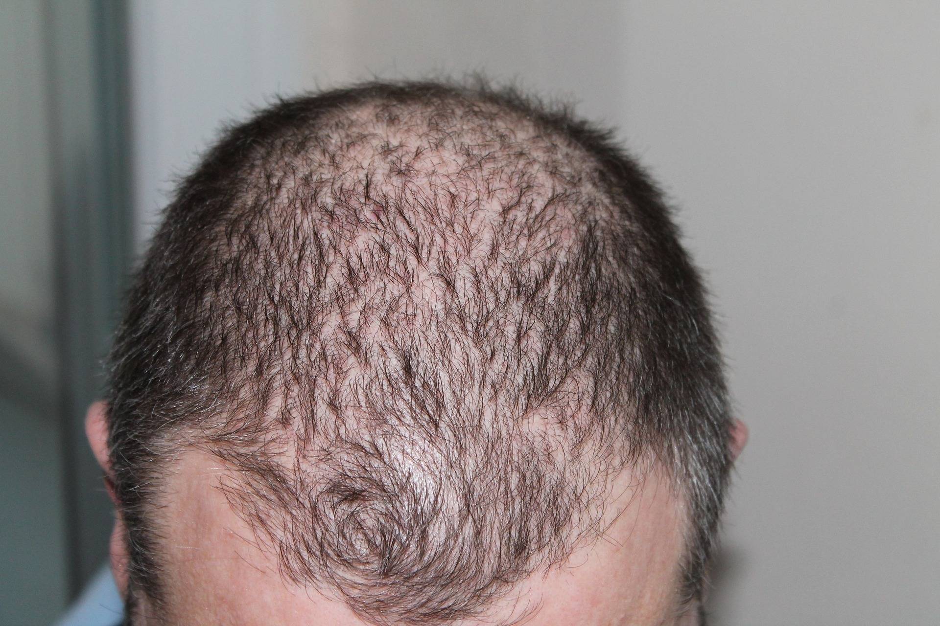 Las enfermedades autoinmunes que provocan la caída del cabello están aumentando, según tricólogos y especialistas capilares