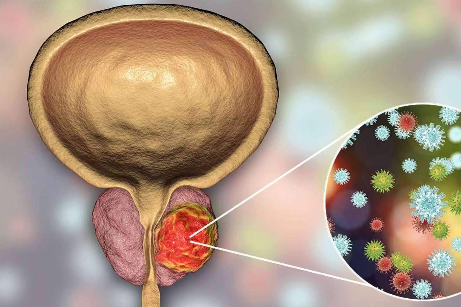 Superar las consecuencias de un cáncer de próstata es posible, por Capenergy