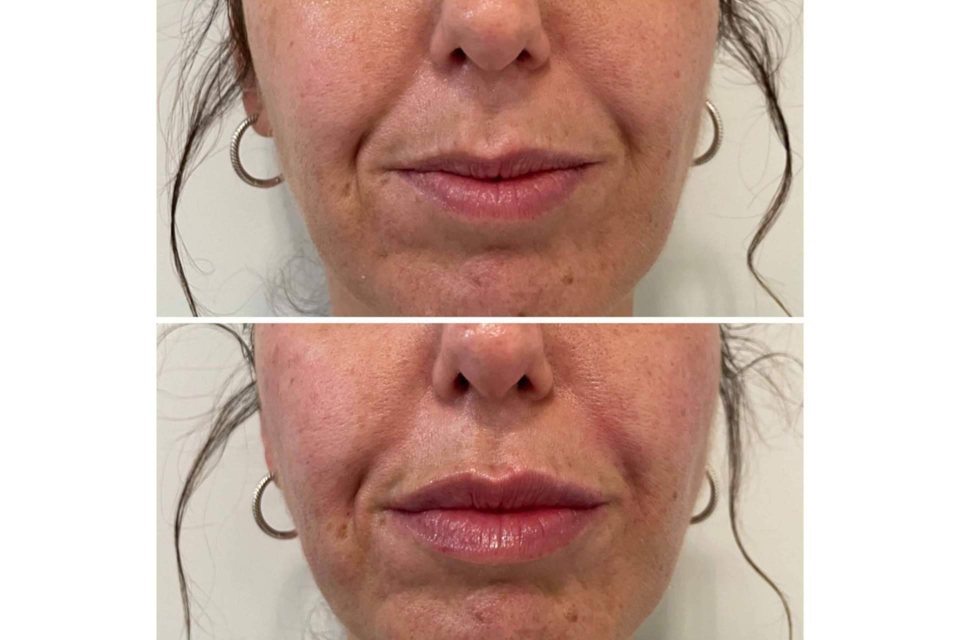 ¿Se puede lograr un aumento de labios en Madrid con resultados naturales?, por la Dra. Cecilia Arthur