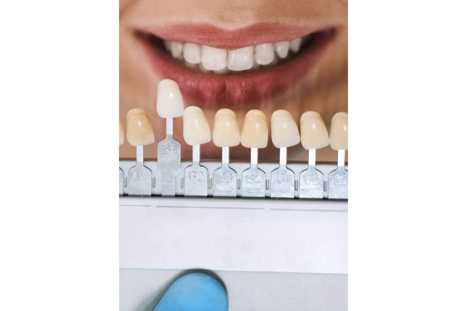 El tratamiento estético dental por excelencia, las carillas dentales
