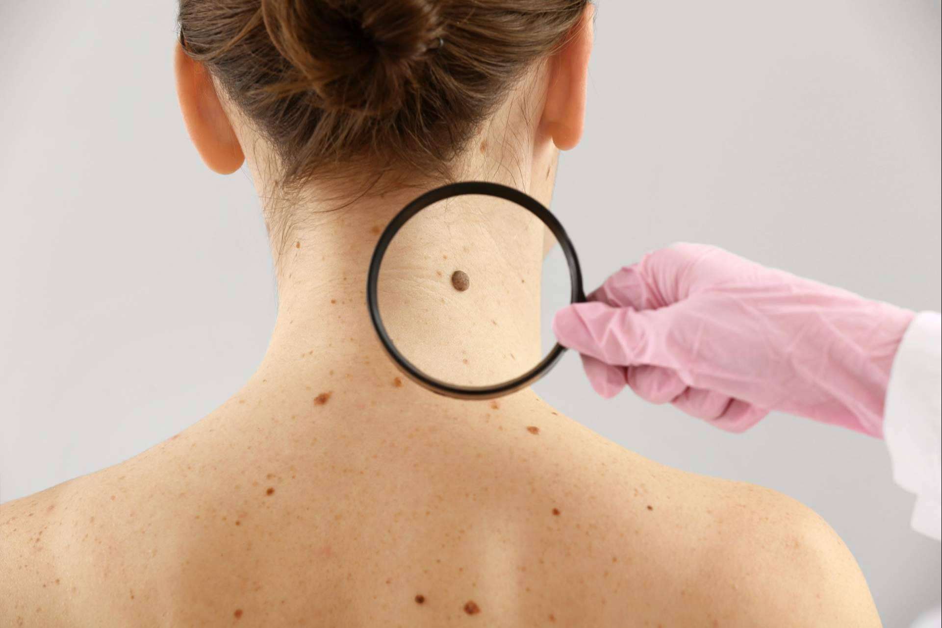 Tecnología de vanguardia para eliminar verrugas y lunares, en el Centro Médico El Pilar