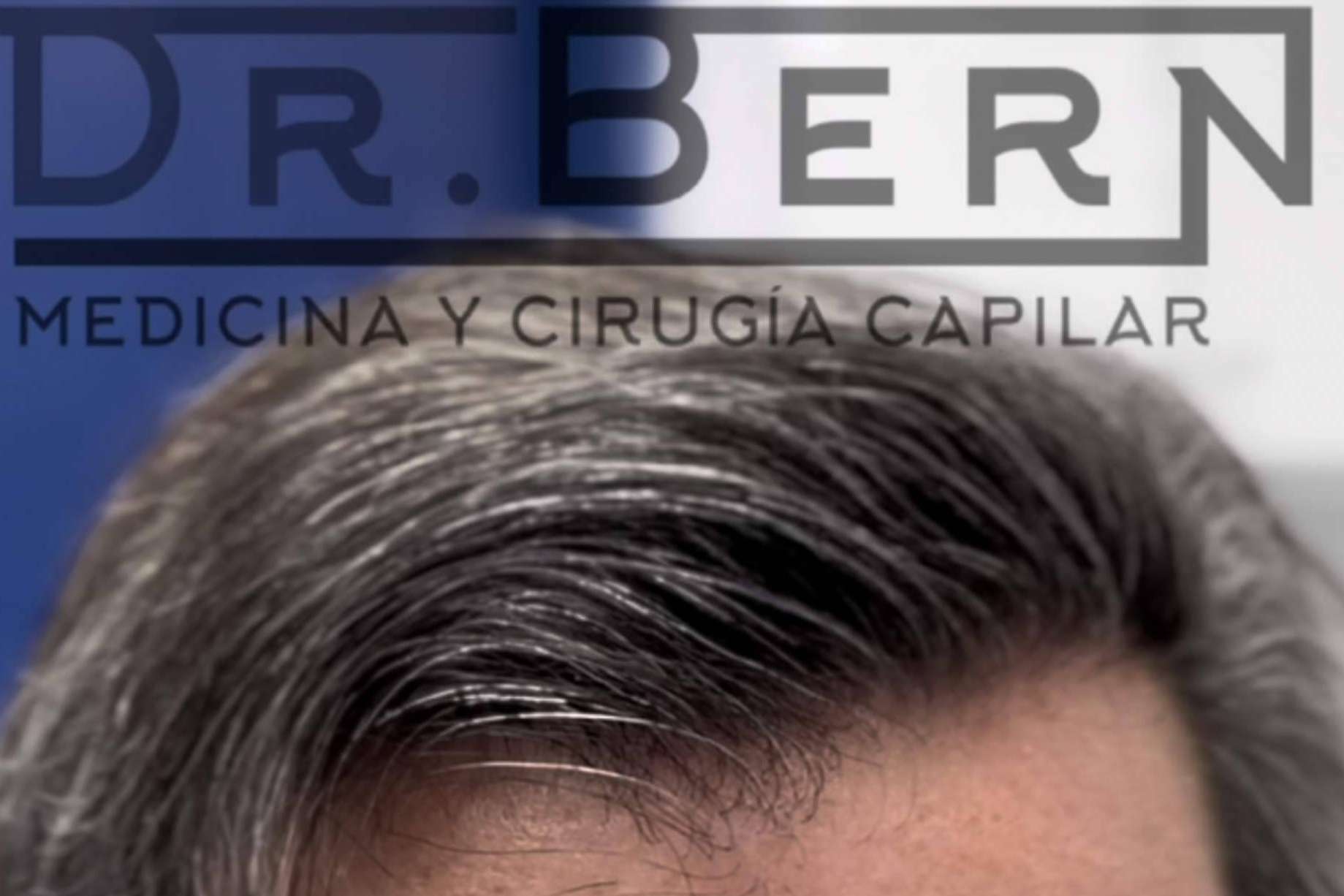 Dr. Bern, premiado por perfeccionar la técnica FUE - DHI y llevar su técnica a distintas partes de Latinoamérica y Europa