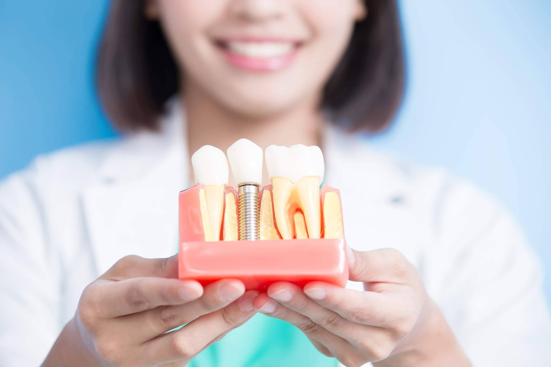 Los diferentes tipos de implantes dentales que existen y los que se deben escoger según las necesidades, por DeltaDent