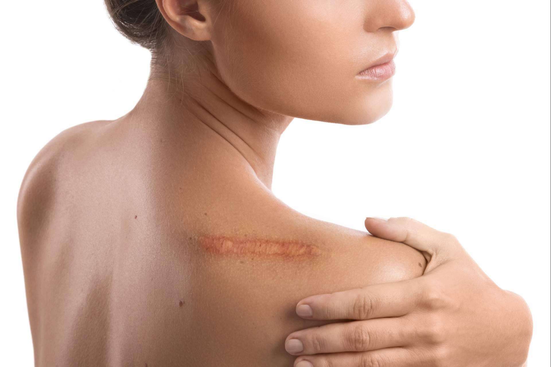 Cuidar las cicatrices en la piel de cara al verano, por los expertos de La Parafarmacia del Puerto