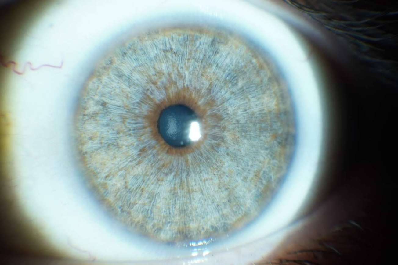 Clínica Eyecos y los avances en las operaciones de cambio de color de ojos con láser