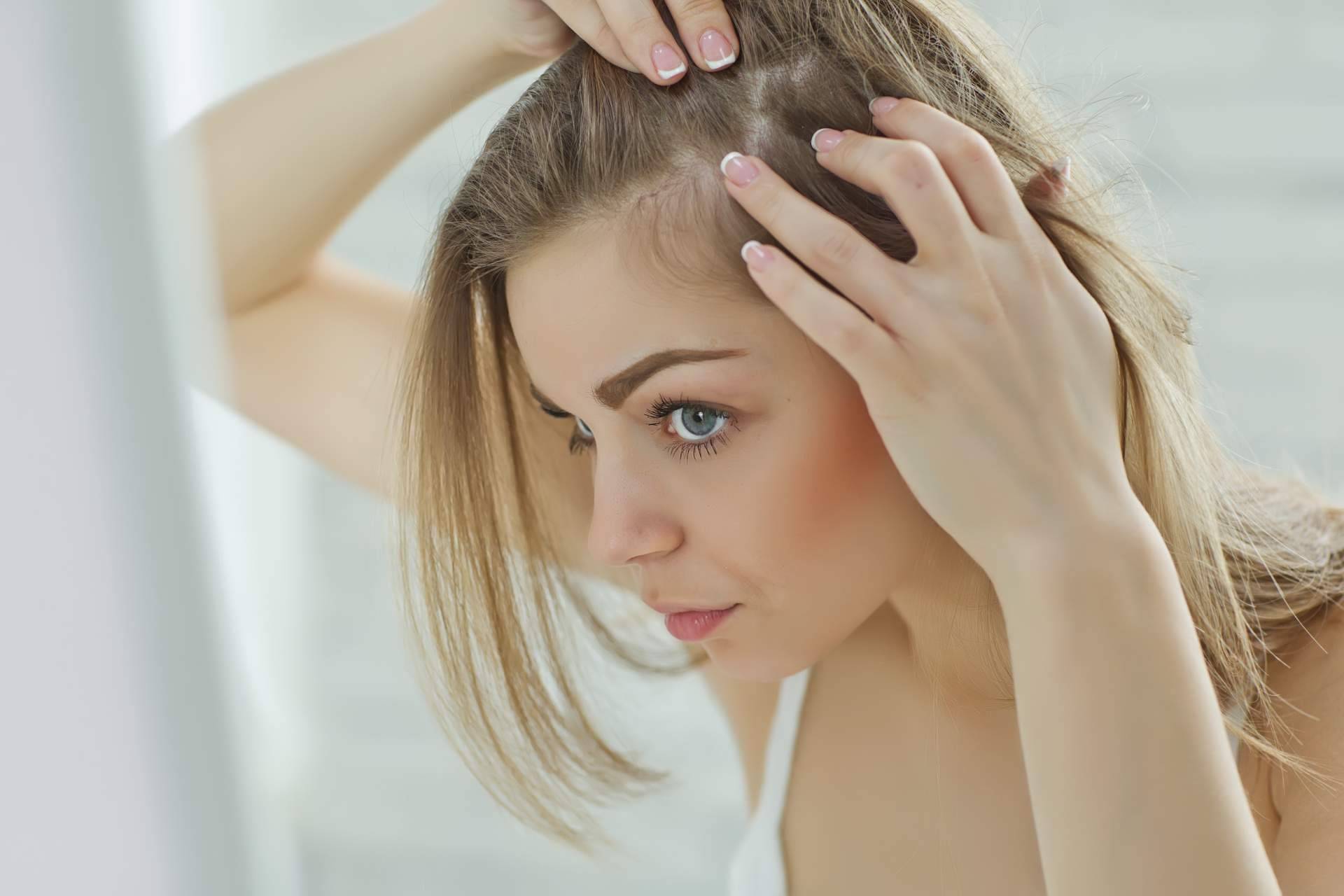 ¿Qué es el efluvio telógeno y cuáles son sus causas?, por Élite Capilar