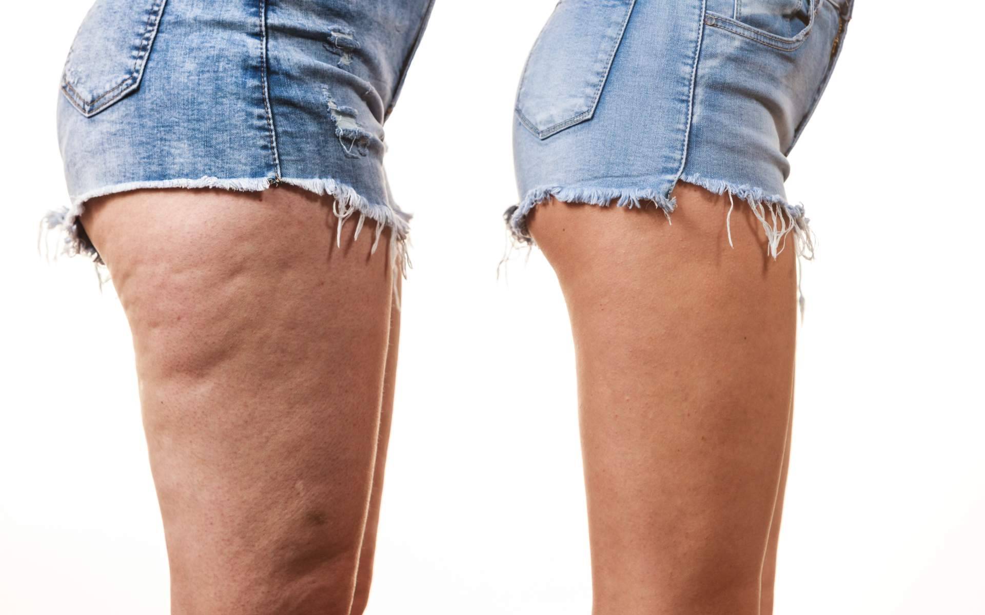 Mesmerie ofrece Vacuslim 48, tratamiento corporal para reducir la celulitis