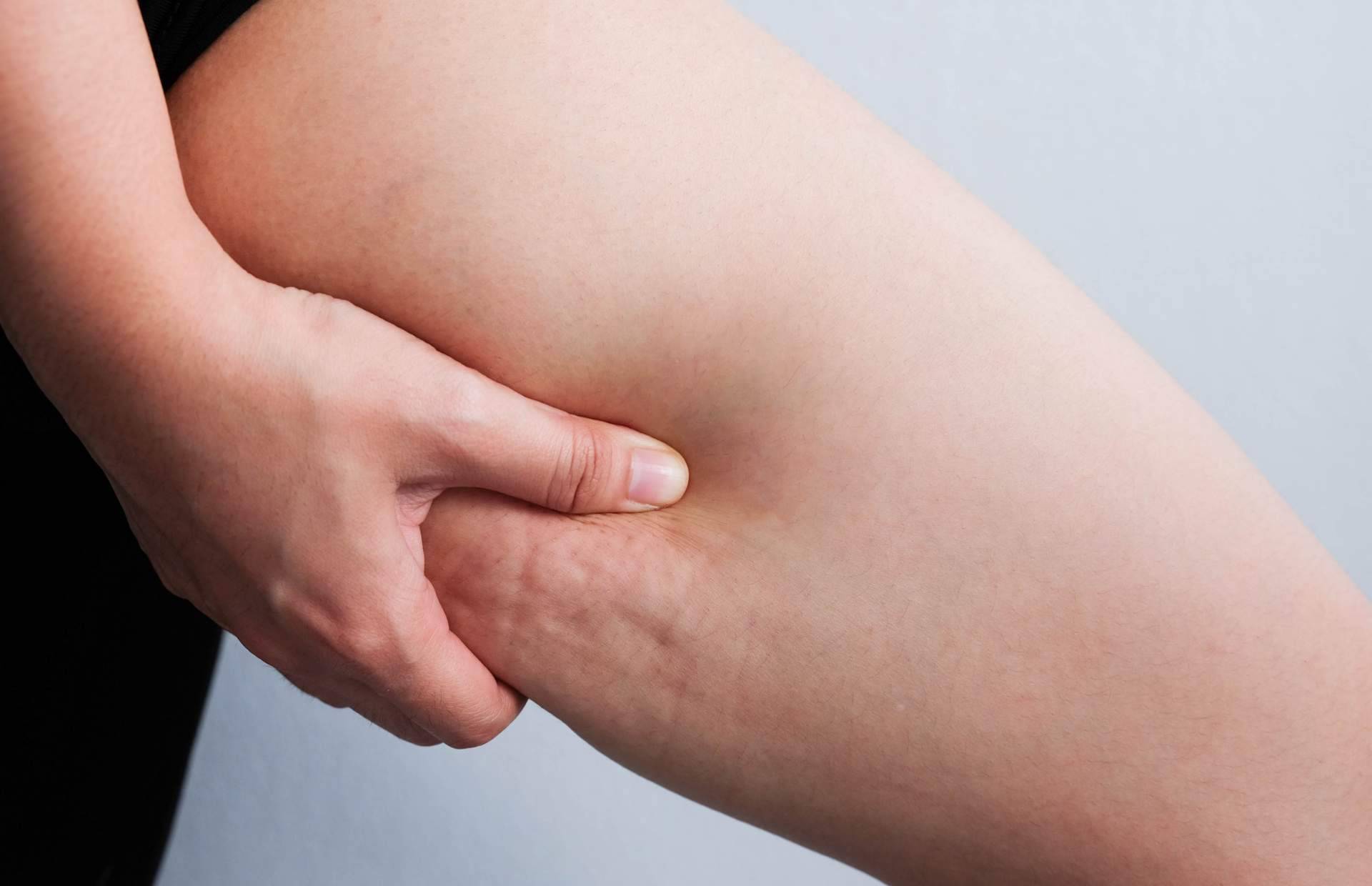 ¿Realmente funciona? Vacuslim 48, tratamiento corporal para tratar y reducir la celulitis
