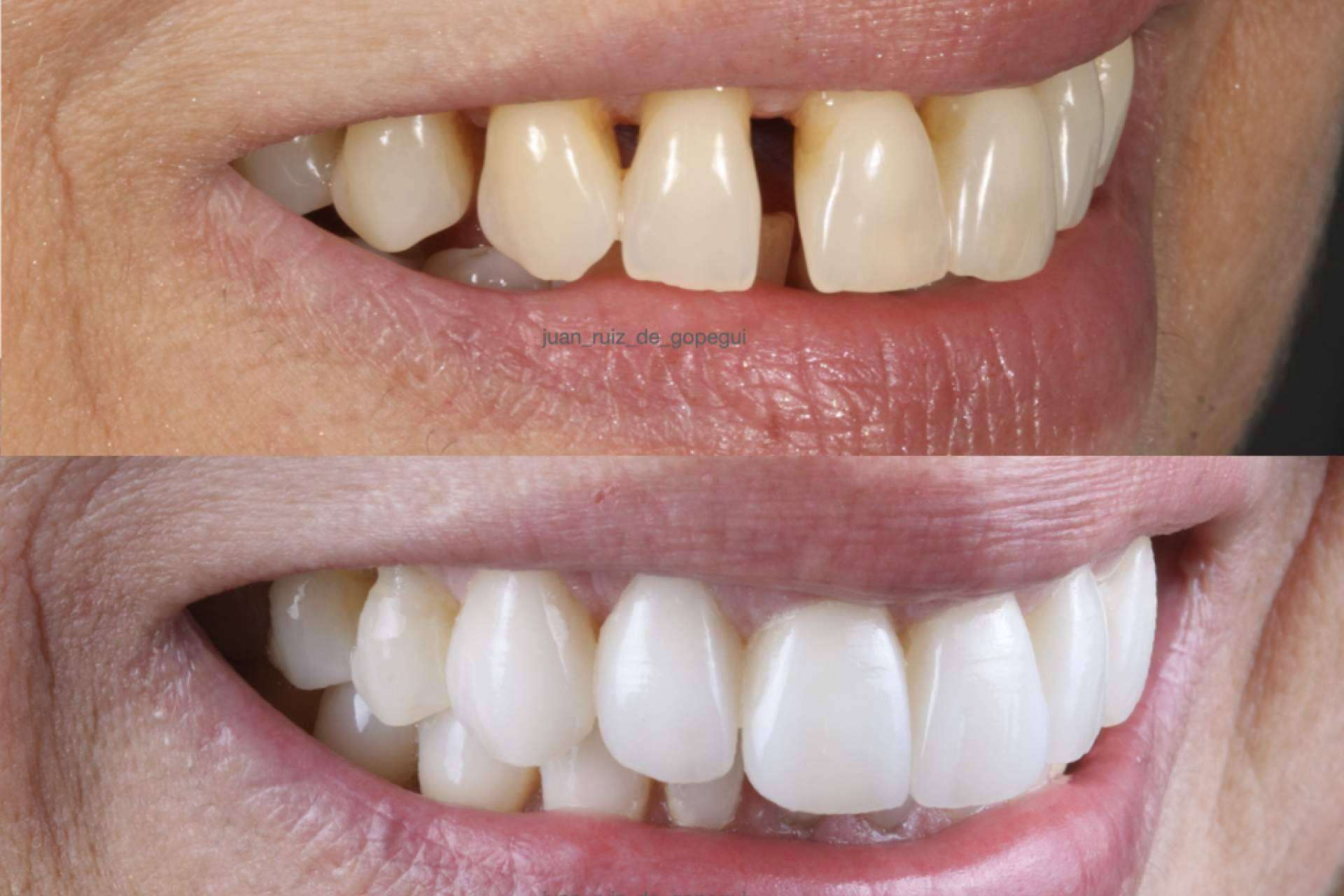 Beneficios de elegir carillas de porcelana para mejorar la sonrisa
