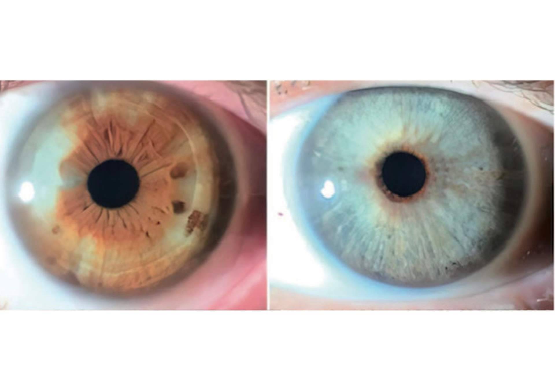 Clínica Eyecos afirma que los heterocromías y los nevus del iris pueden ser tratados con láser