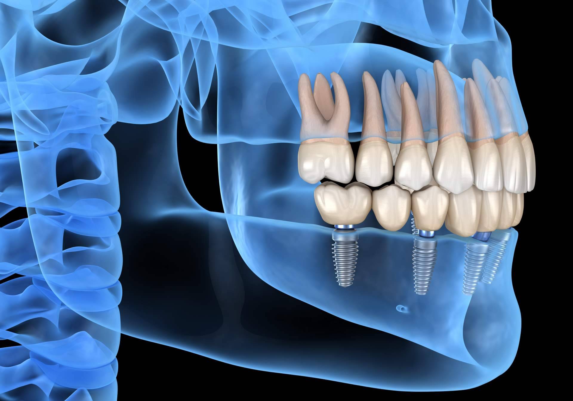 La Clínica Dental de la Doctora Cachero ofrece implantes dentales