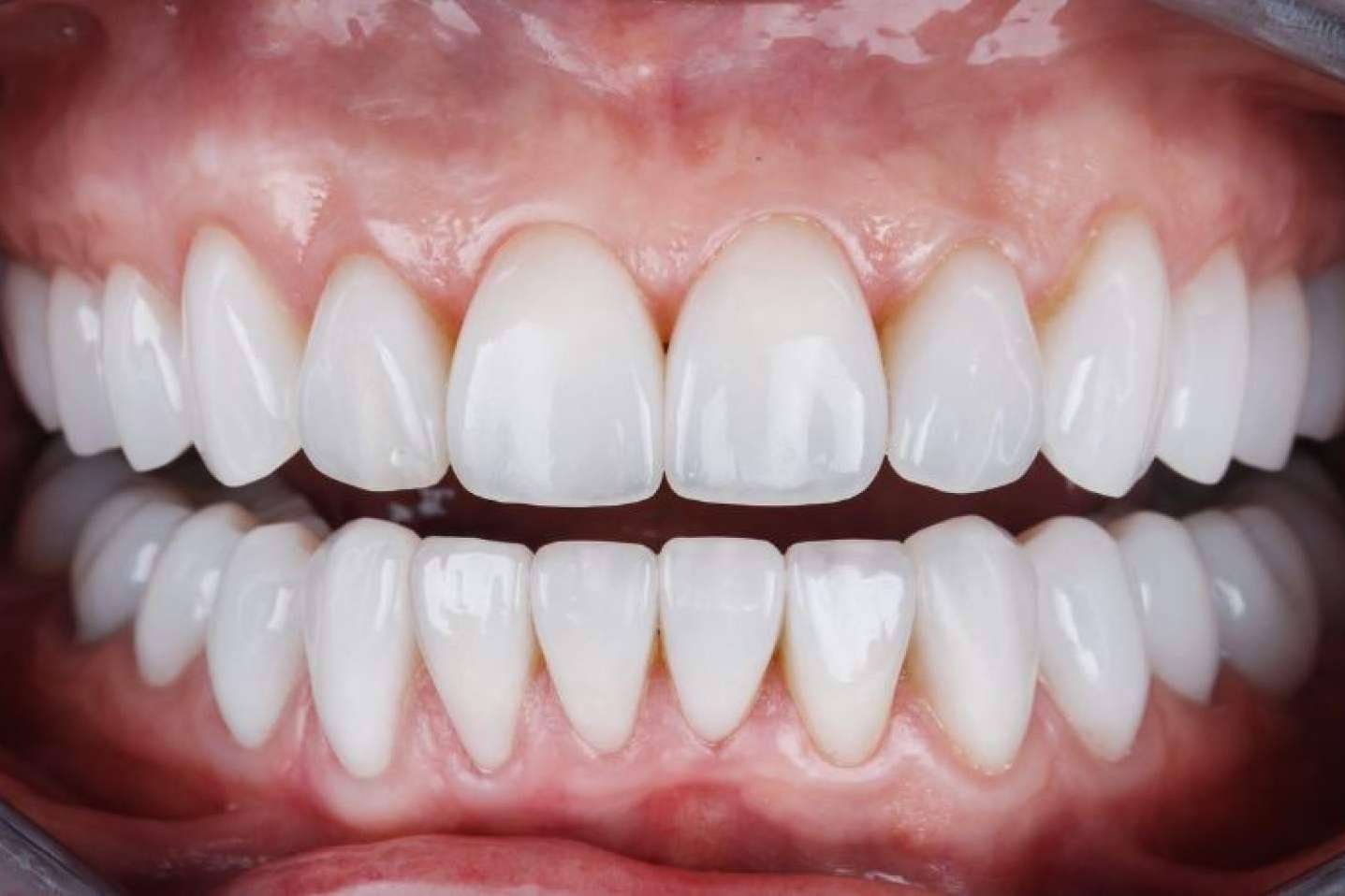 ¿Cuáles son los beneficios de las carillas de composite?, con Clínica Dental Ruiz de Gopegui