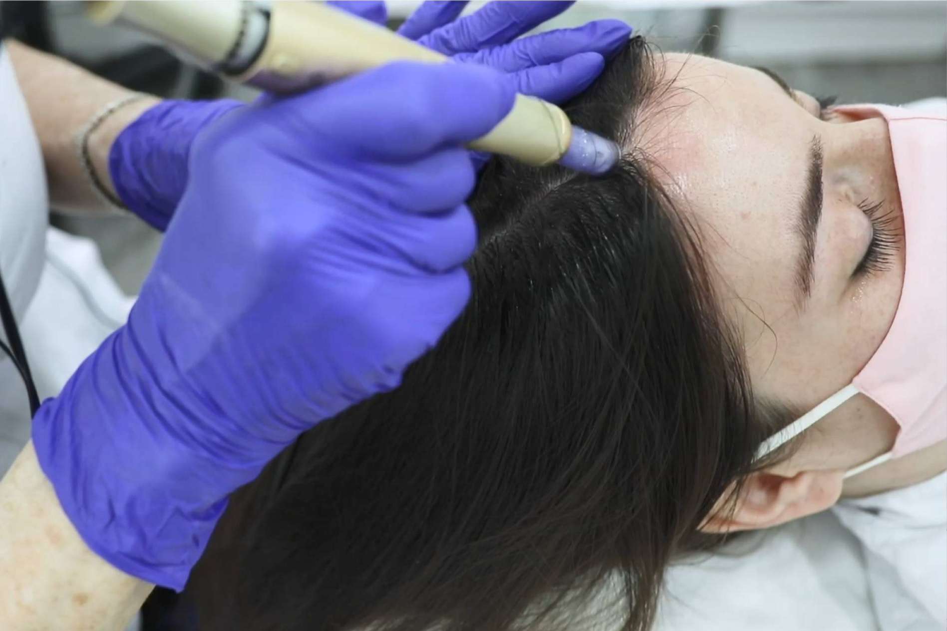 Tratar la alopecia femenina con el tratamiento bioestimulación de IMD Instituto Médico Dermatológico