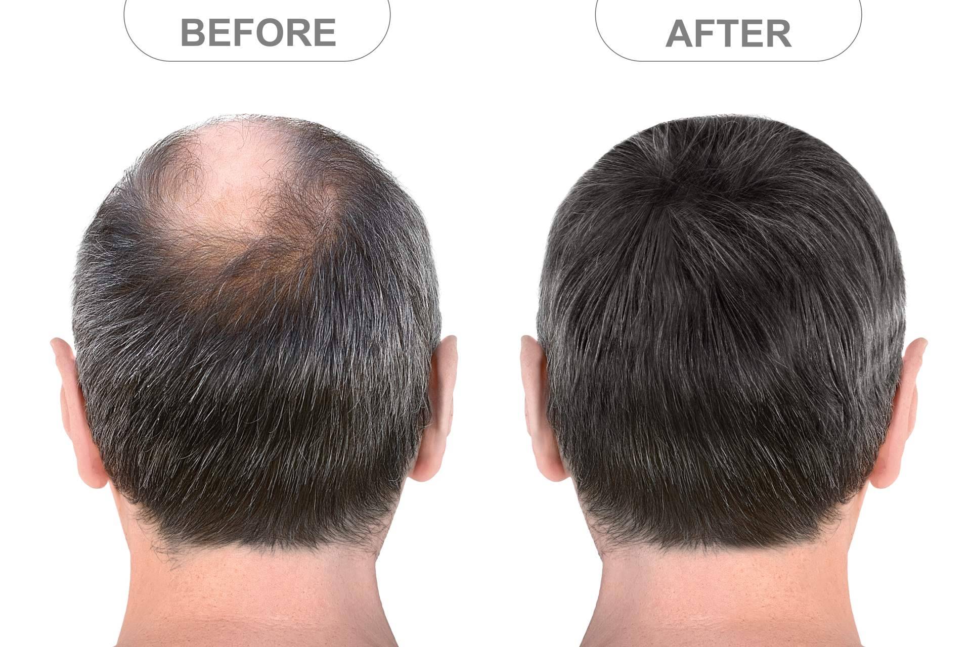 Microinjerto capilar FUE, solución definitiva y mínimamente invasiva para los casos de alopecia androgénica