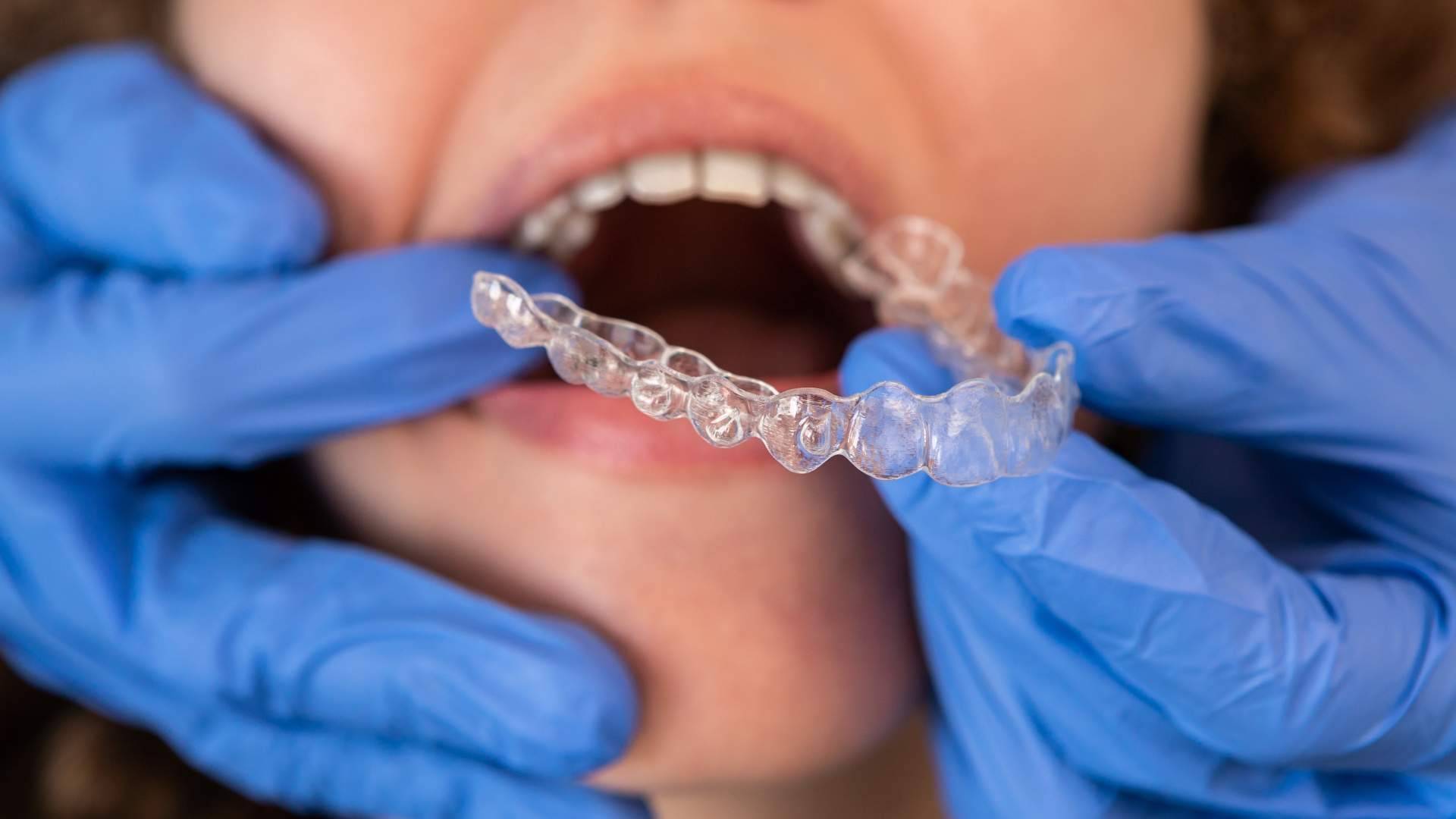 Clínica Dentinos ofrece tratamientos de ortodoncia invisible en Málaga