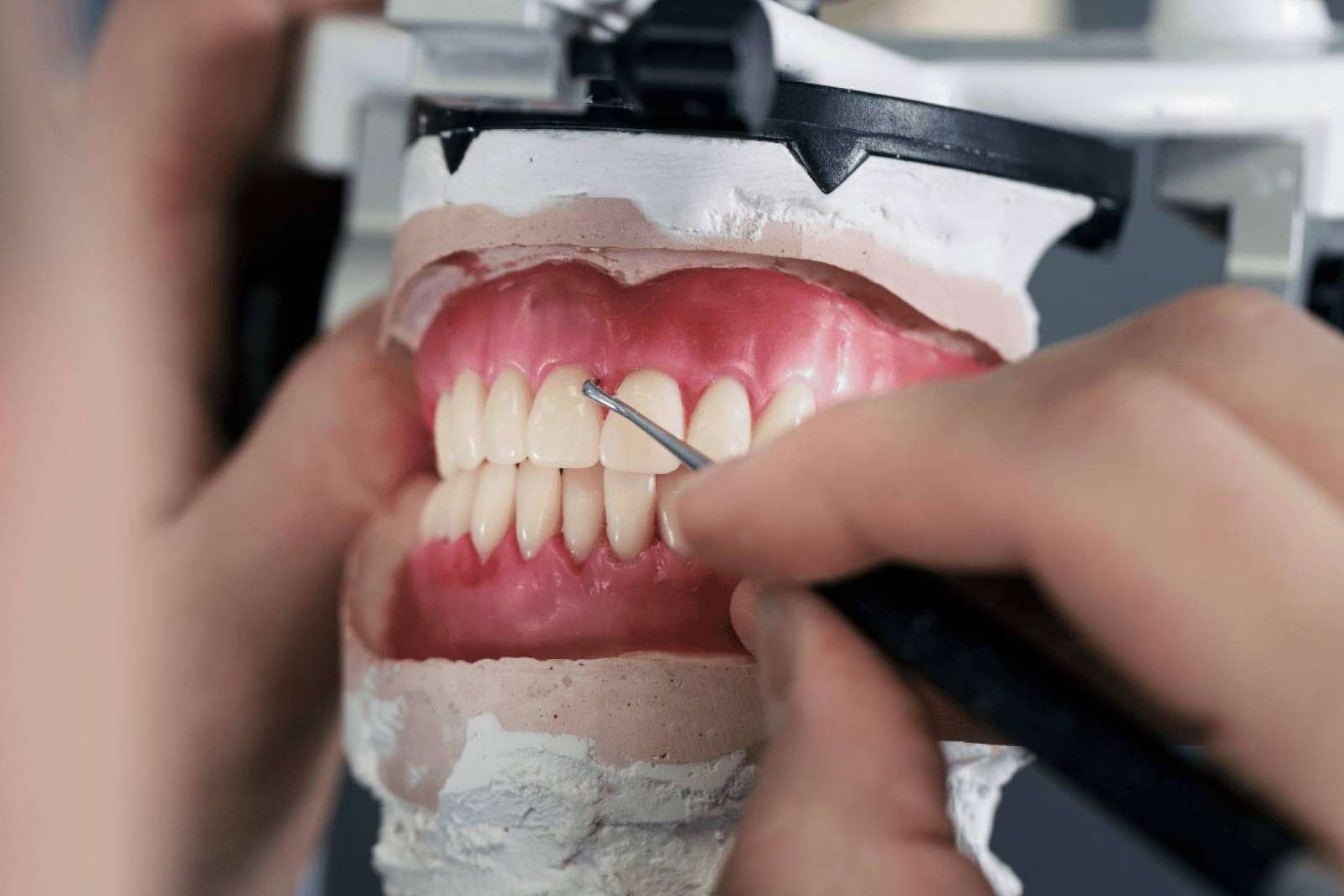 Coronas dentales, la solución estética y duradera para recuperar la sonrisa perfecta por la Clínica Dental Ruiz de Gopegui
