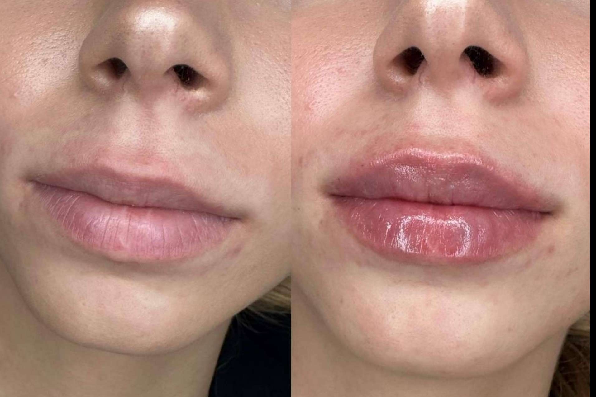 Conseguir unos labios 100 % naturales gracias a la técnica en dos pasos de la doctora Sandra Hermida