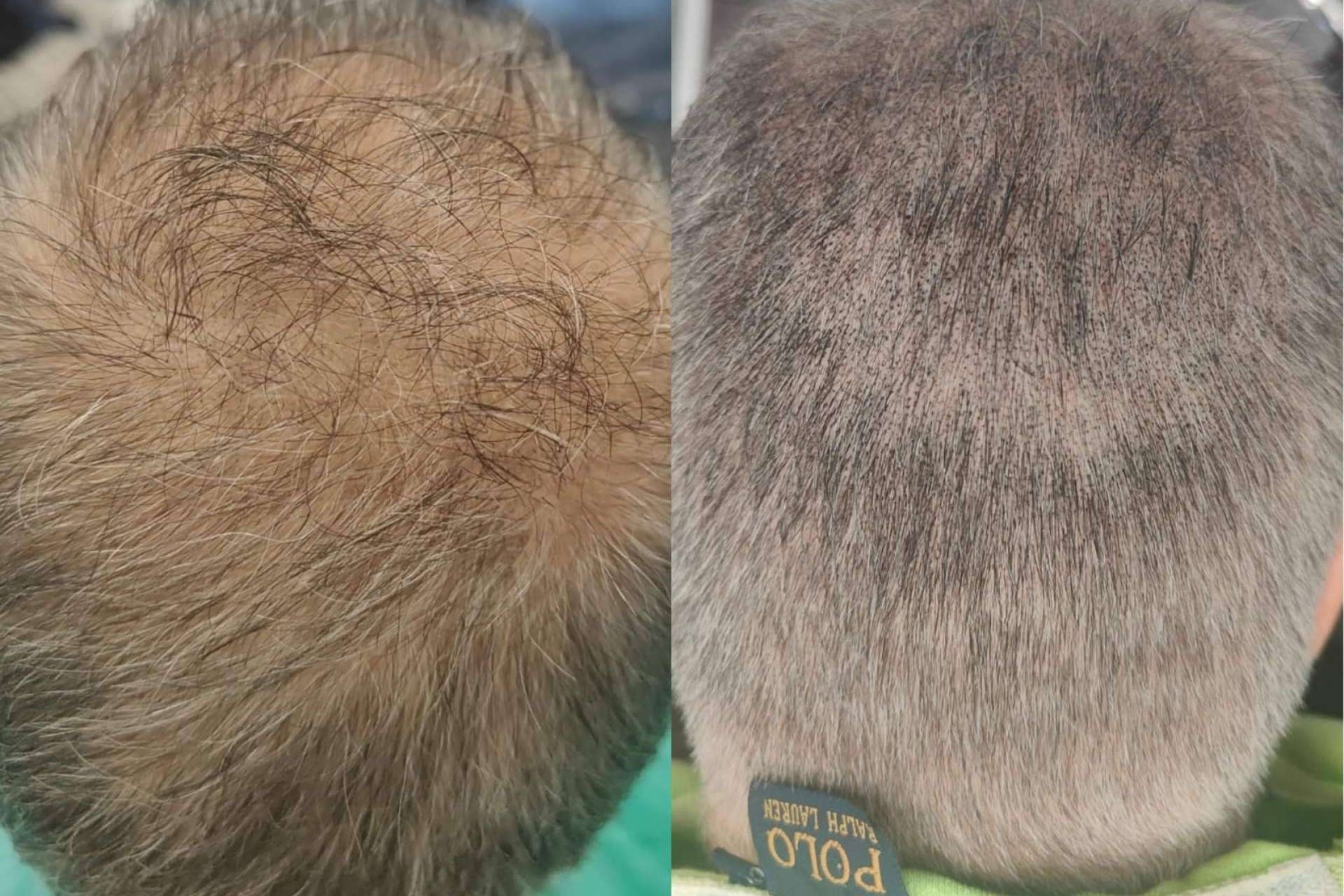 ¿Cuáles son los beneficios de la micropigmentación capilar?, por Dermopigmentación Clínica