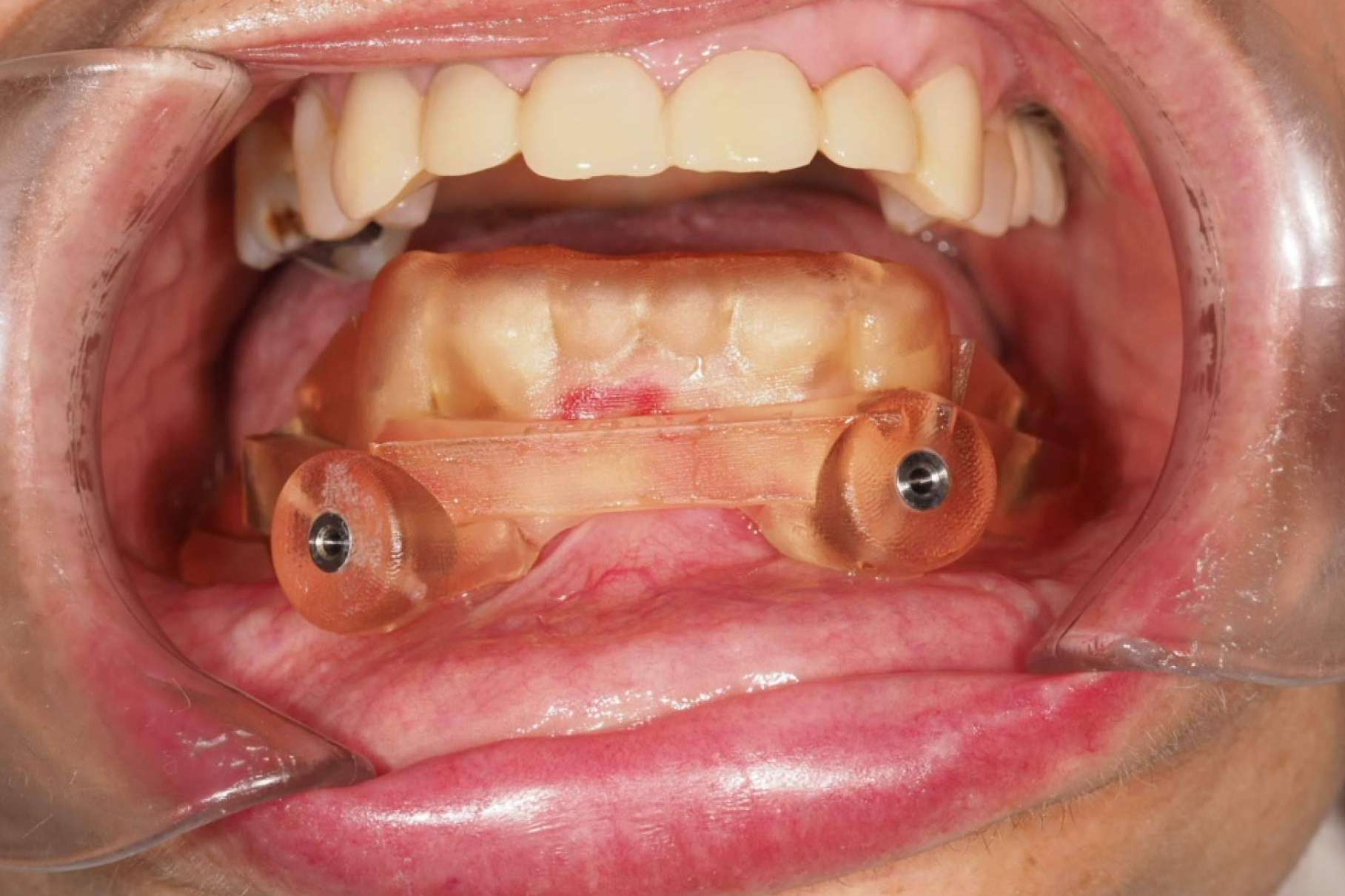 Implantes dentales en los casos más complicados, de la mano de Centro Nacional de Cirugía Bucomaxilofacial e Implantes