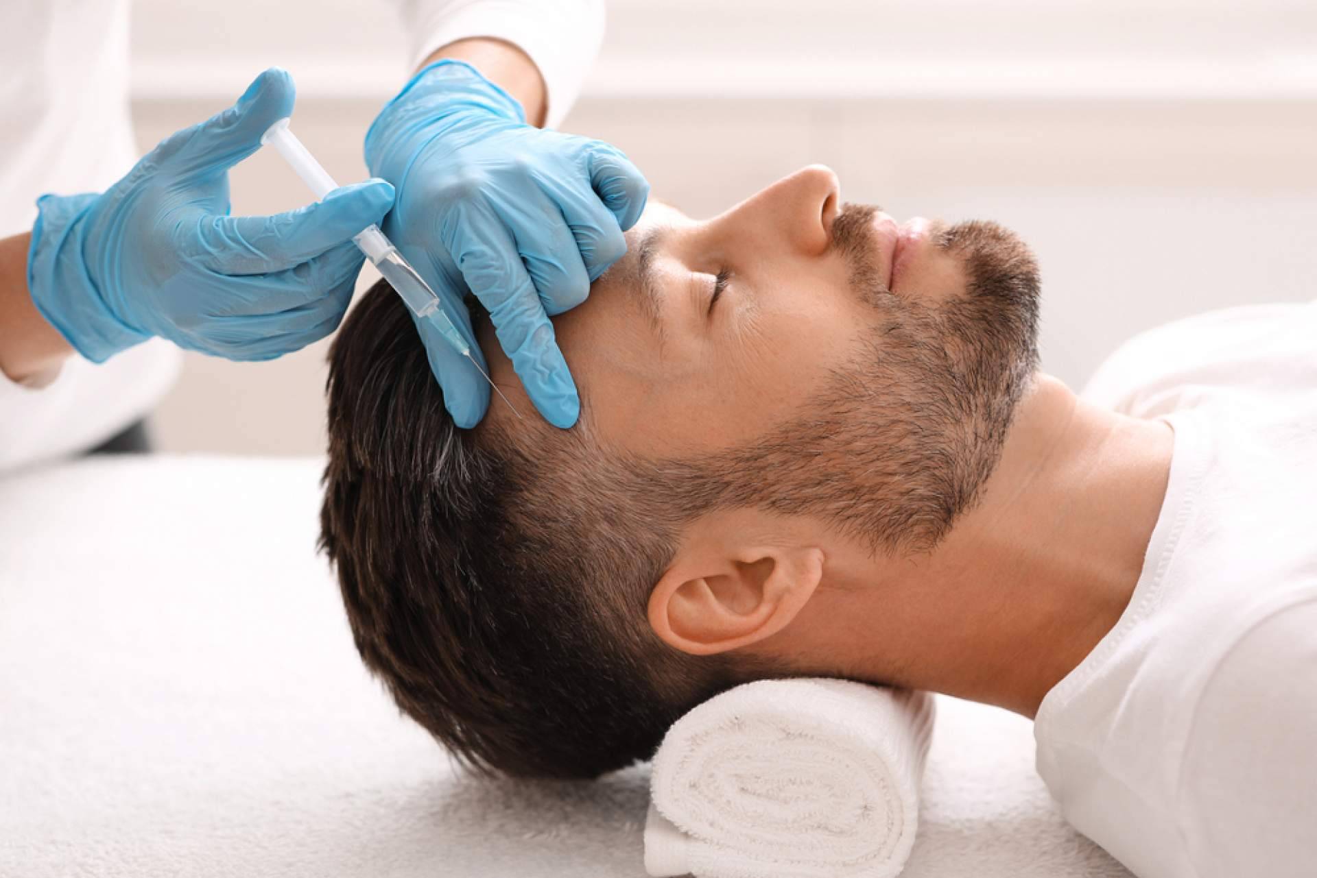 Combatir la caída del cabello con mesoterapia capilar, una terapia sin cirugía