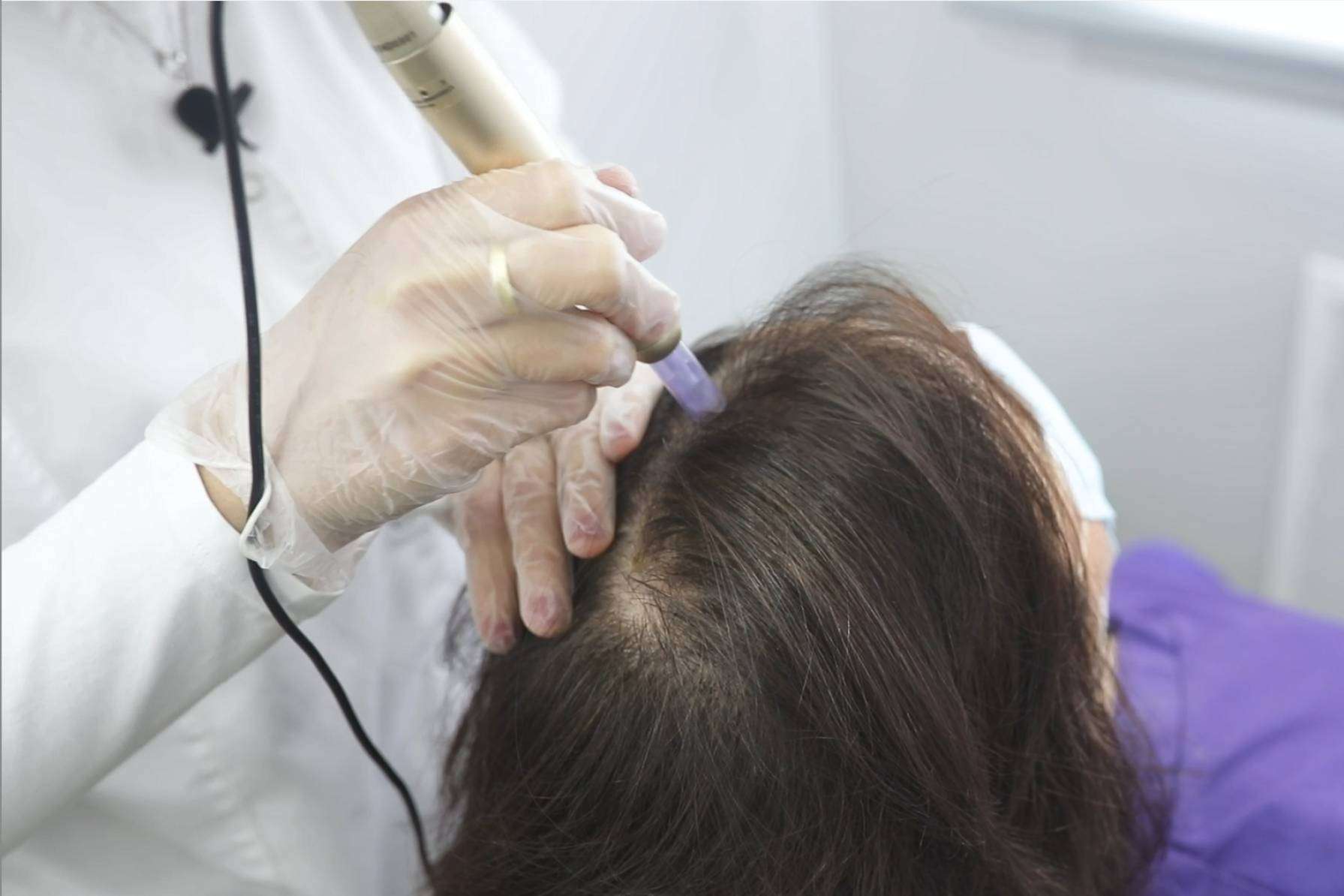 IMD lleva más de 20 años poniendo solución a la alopecia areata