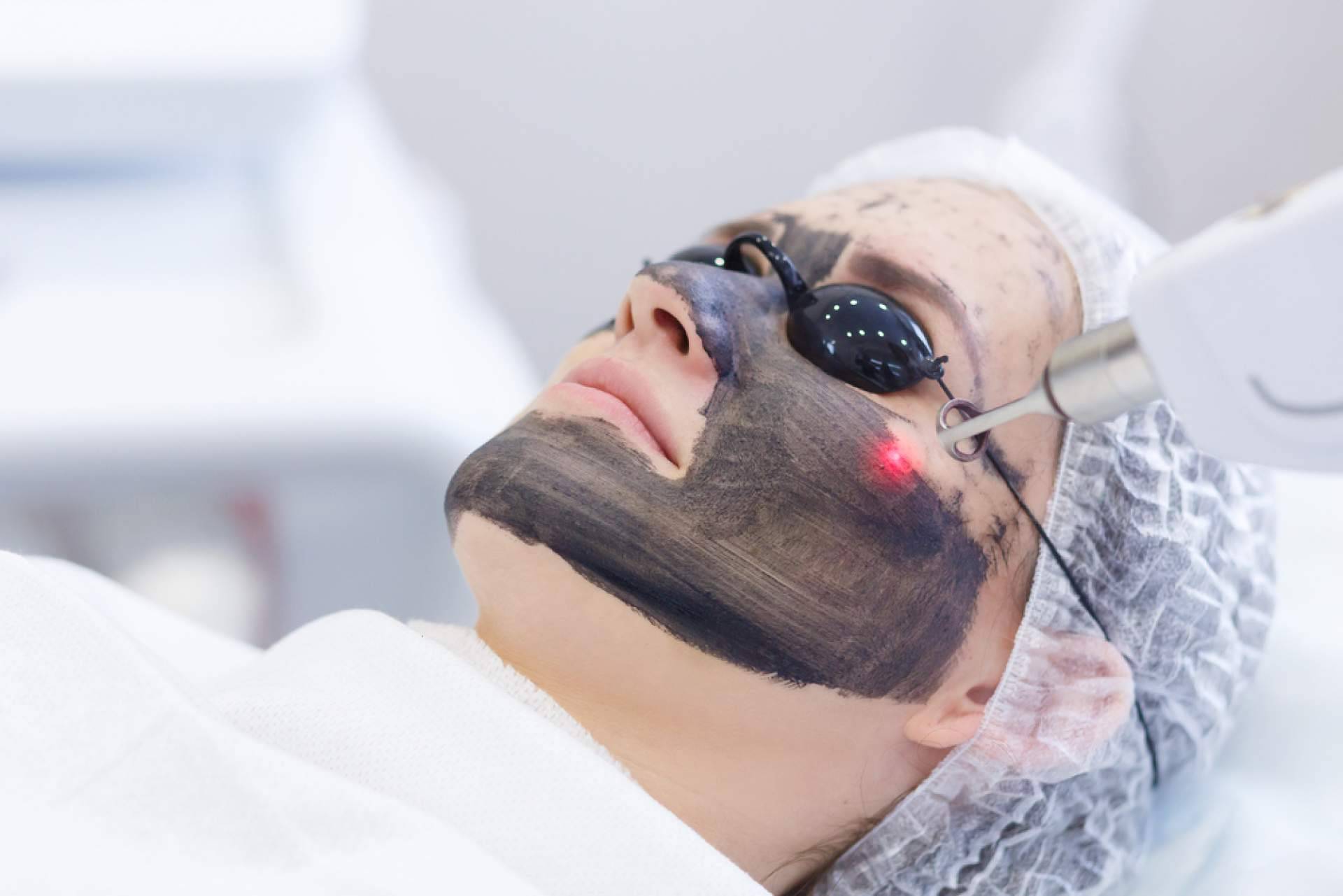 Los beneficios del carbon peel, de la mano de Crina Rus Beauty Center