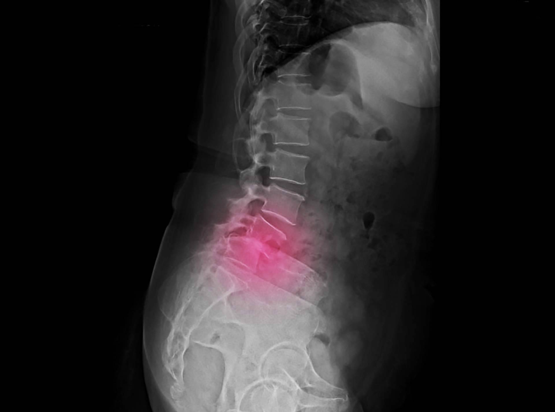 ¿Cuáles son las causas de la espondilolistesis?, por iXalud