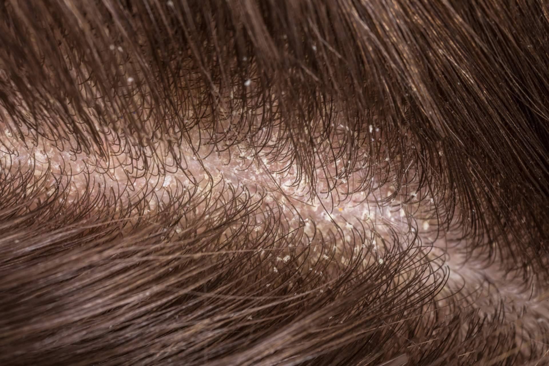 ¿Cuáles son los beneficios del peeling capilar?, por Malecare