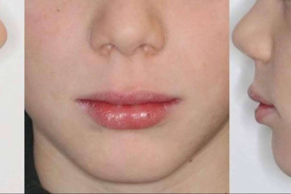 Clínica Zahara explica qué es el mentón Fuyant y cómo tratarlo