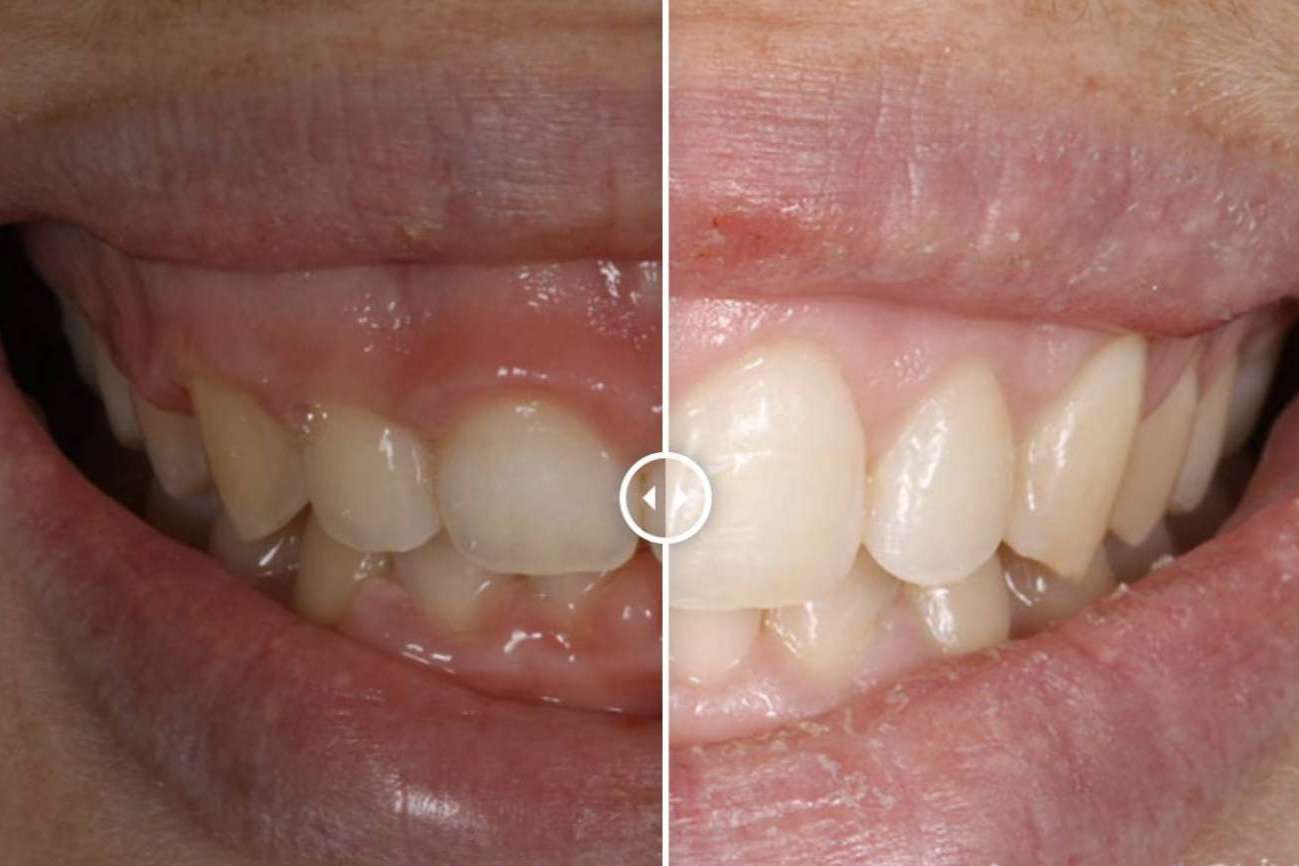 ¿Cómo corregir la sonrisa gingival?, por Clínica Dental Ruiz de Gopegui