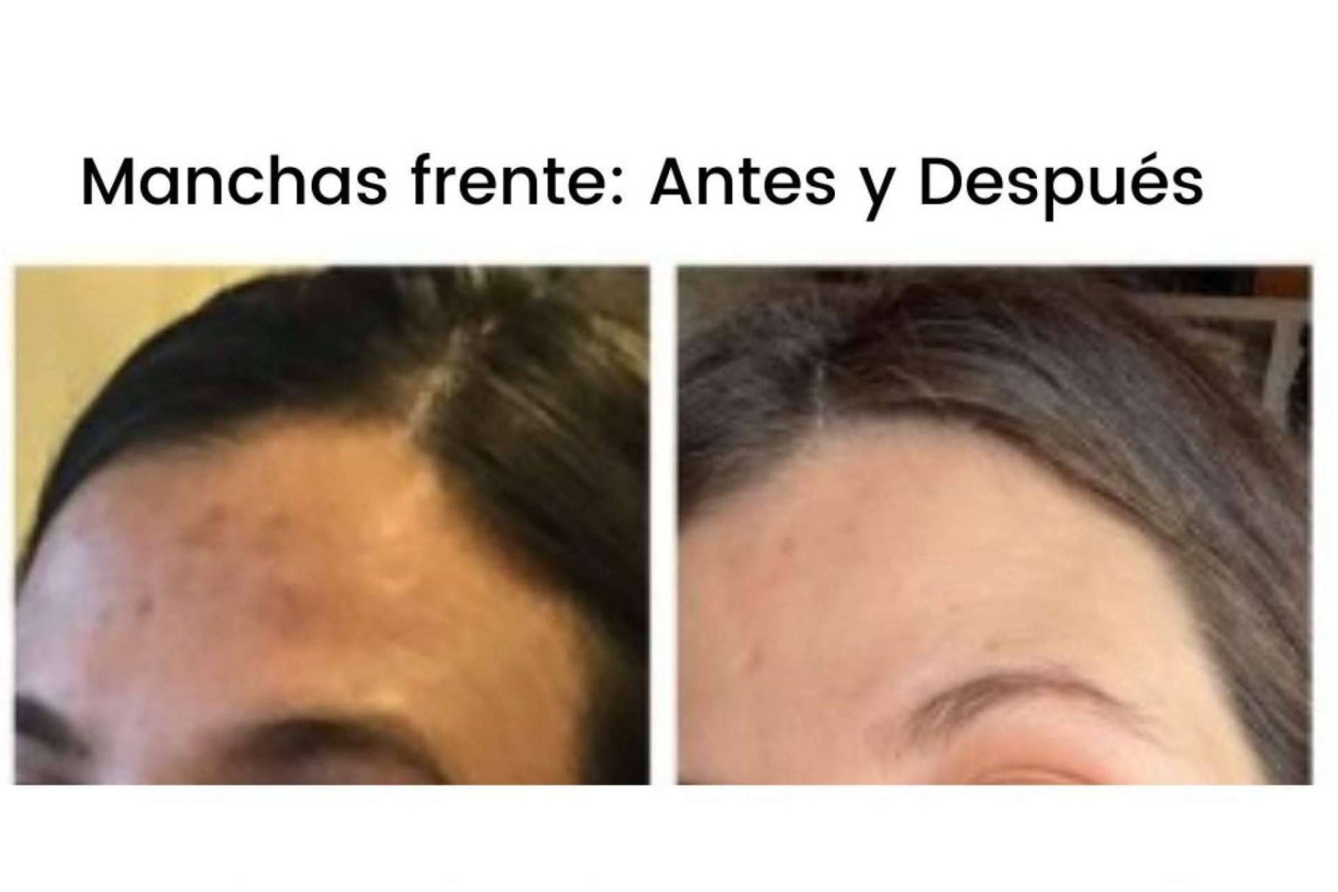 Tratamiento skincare con despigmentante facial para después del verano