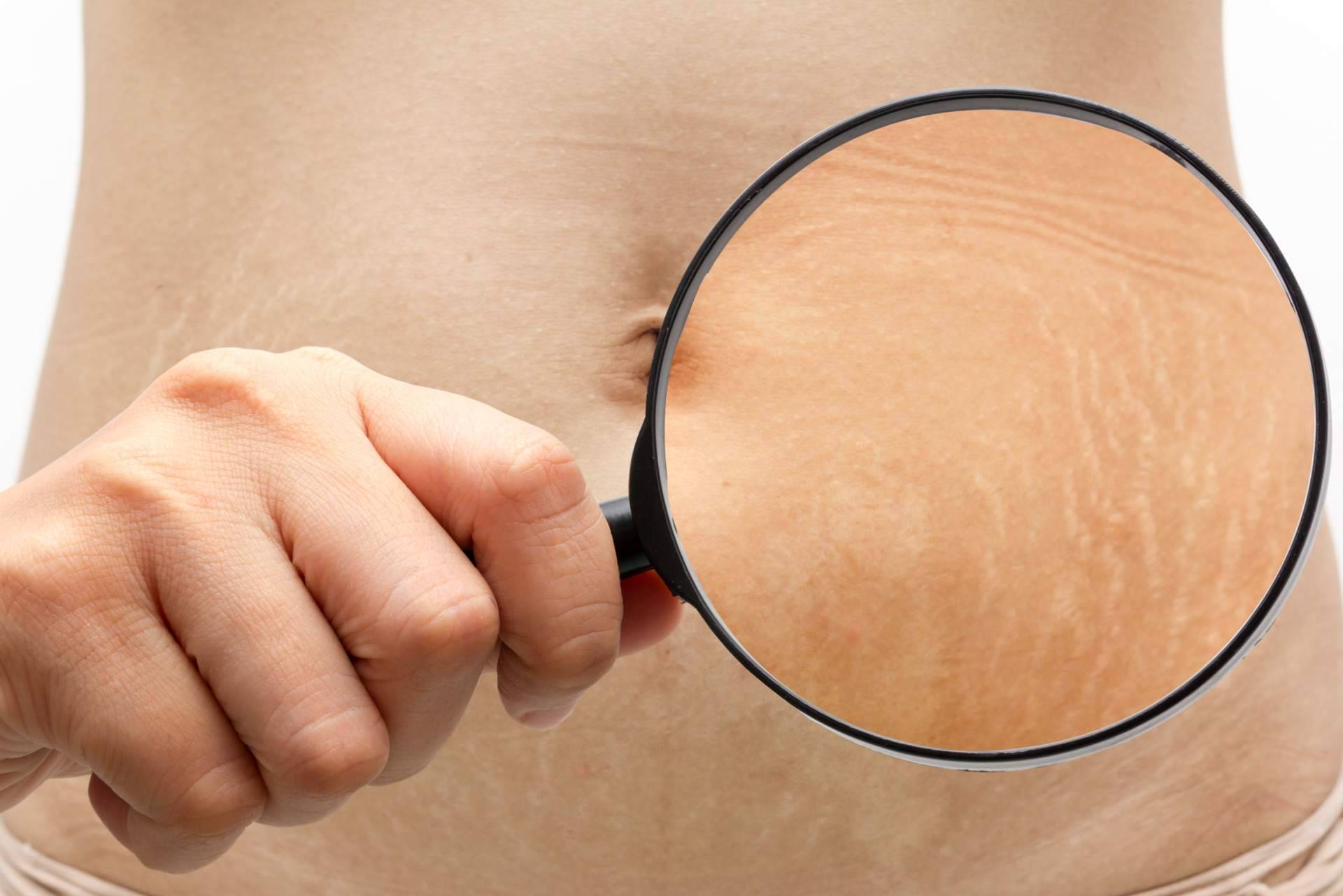 Centro Estética el Pilar cuenta con un tratamiento para quitar estrías indoloro y no invasivo