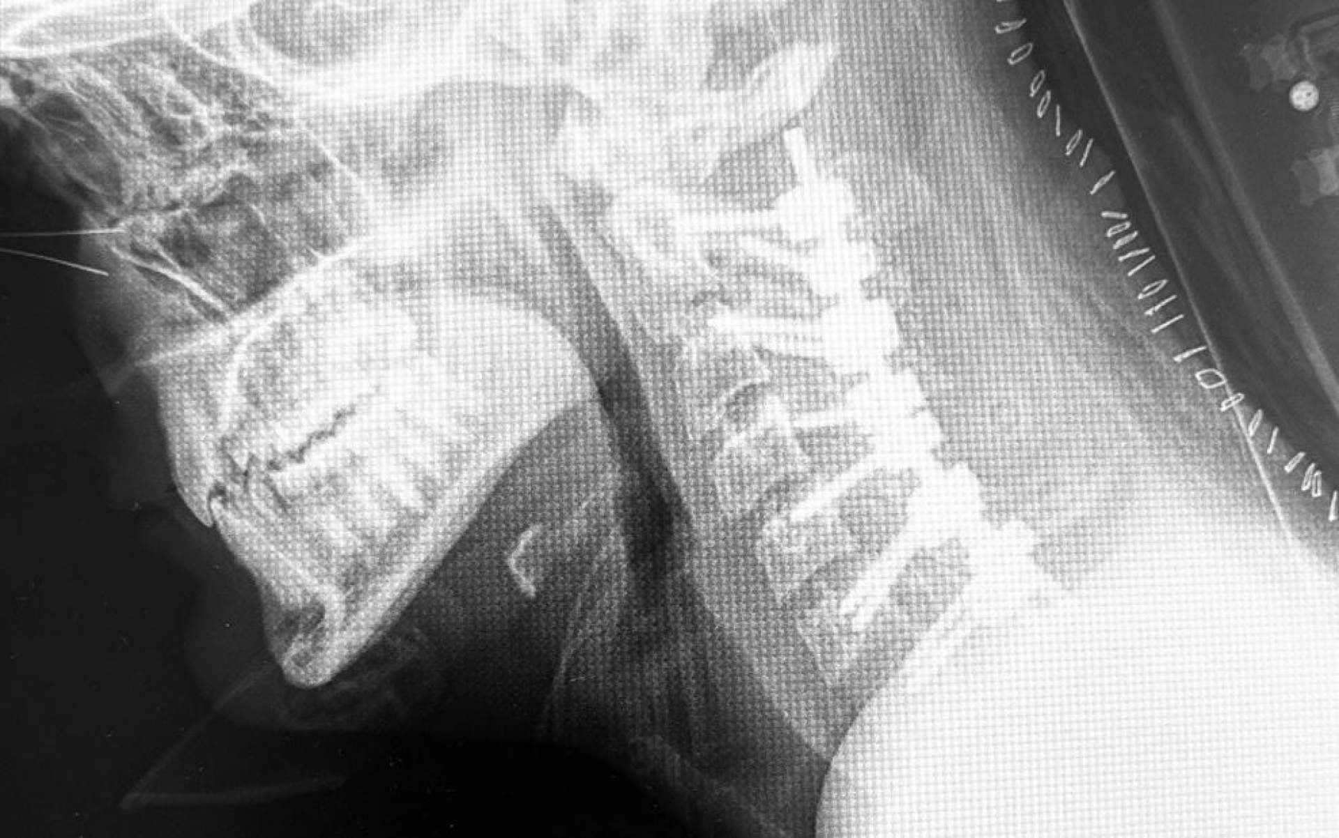 El Dr. Botella-Asunción habla de la cifosis post-laminectomía cervical