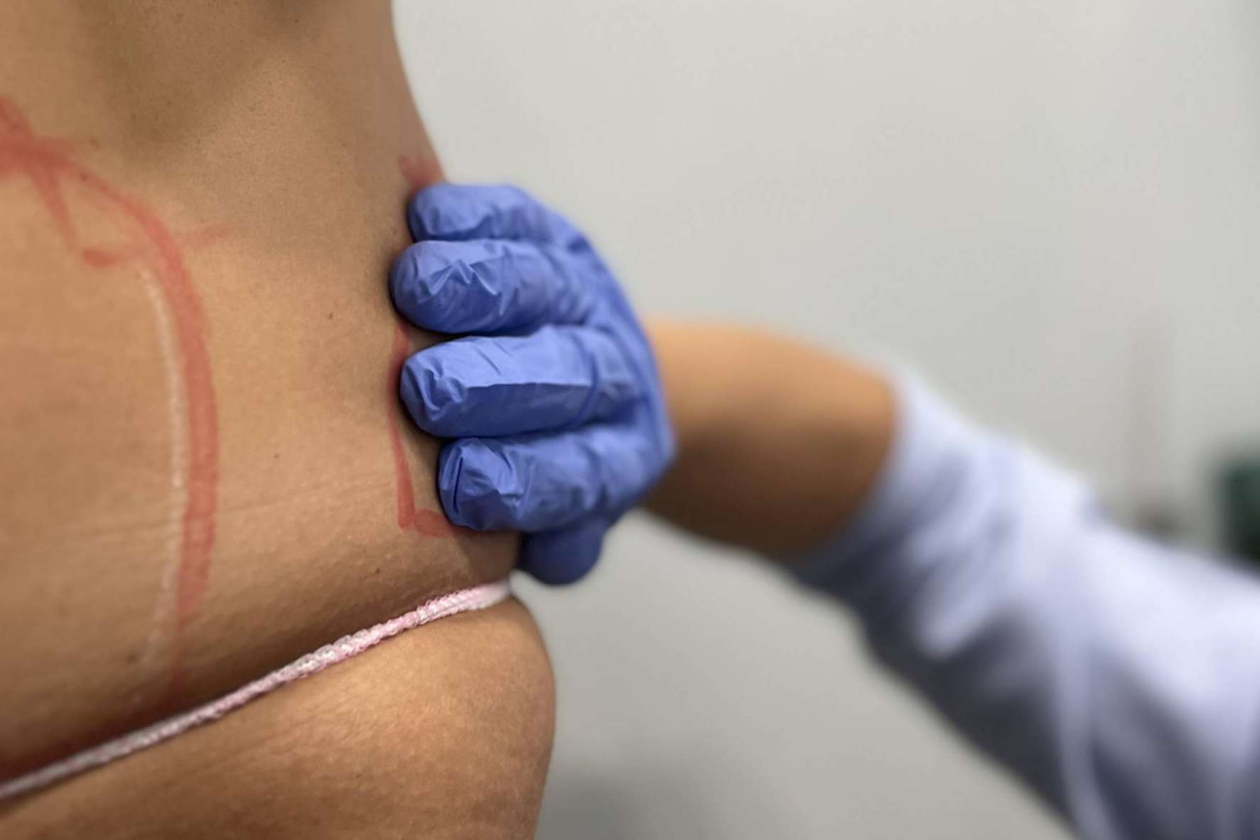 360Clinics ayuda a reducir grasa localizada con el Método Láserfit Medical, un tratamiento revolucionario