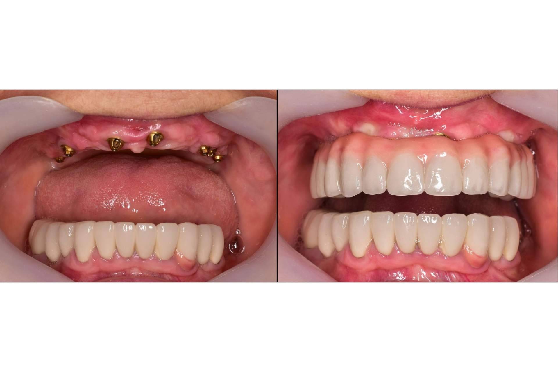 DeltaDent habla sobre los beneficios de un implante dental