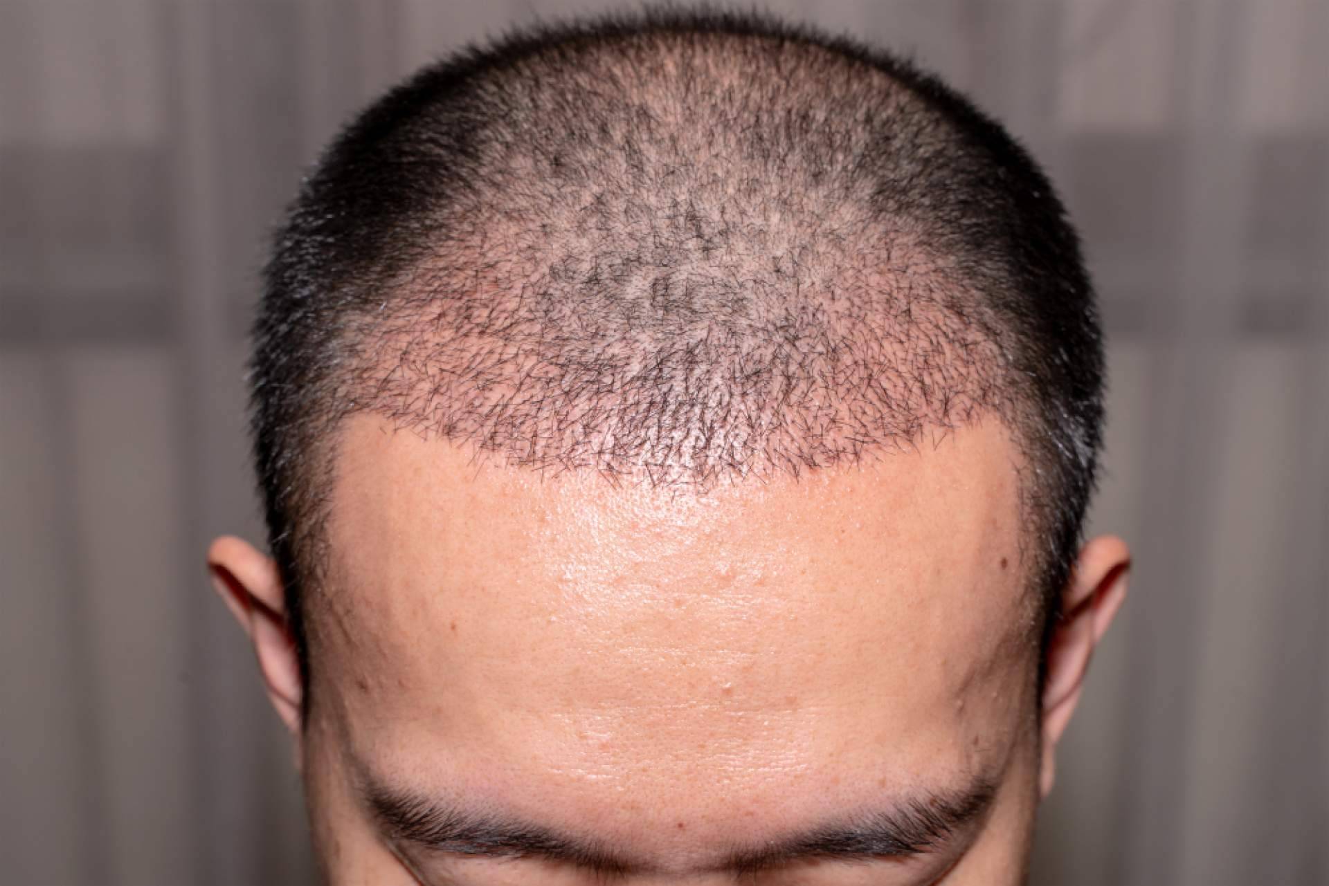 MC360, expertos en injertos de pelo