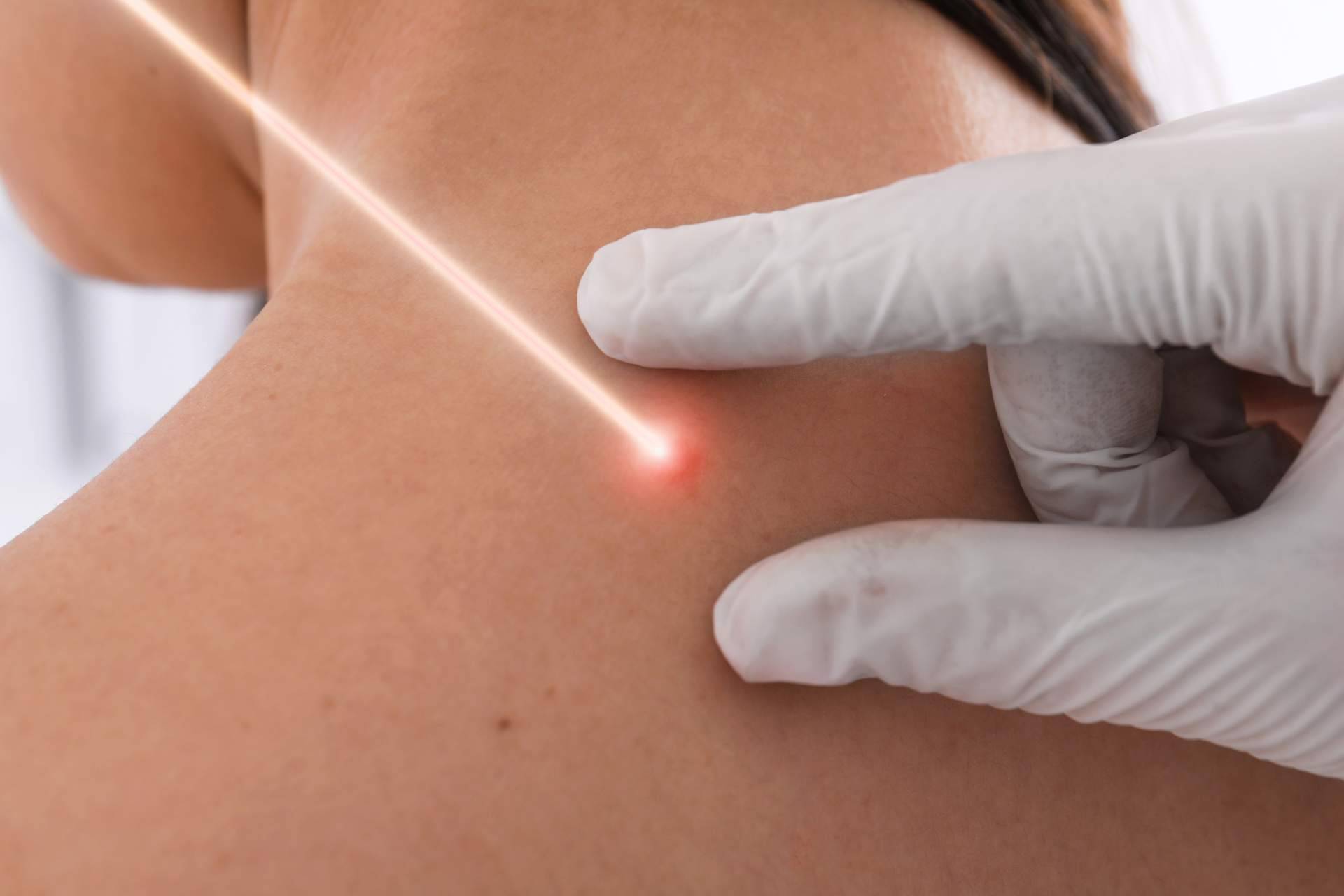 Los servicios de Centro Estética El Pilar permiten eliminar manchas en la piel con láser