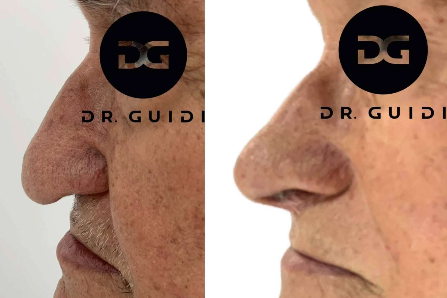 El Dr. Guidi ofrece tratamientos de rinomodelación en su clínica